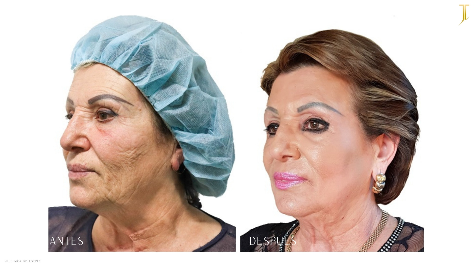 Peeling Profundo. Medicina y Cirugía Estética Facial y Corporal en Valencia Dr. Jorge Torres