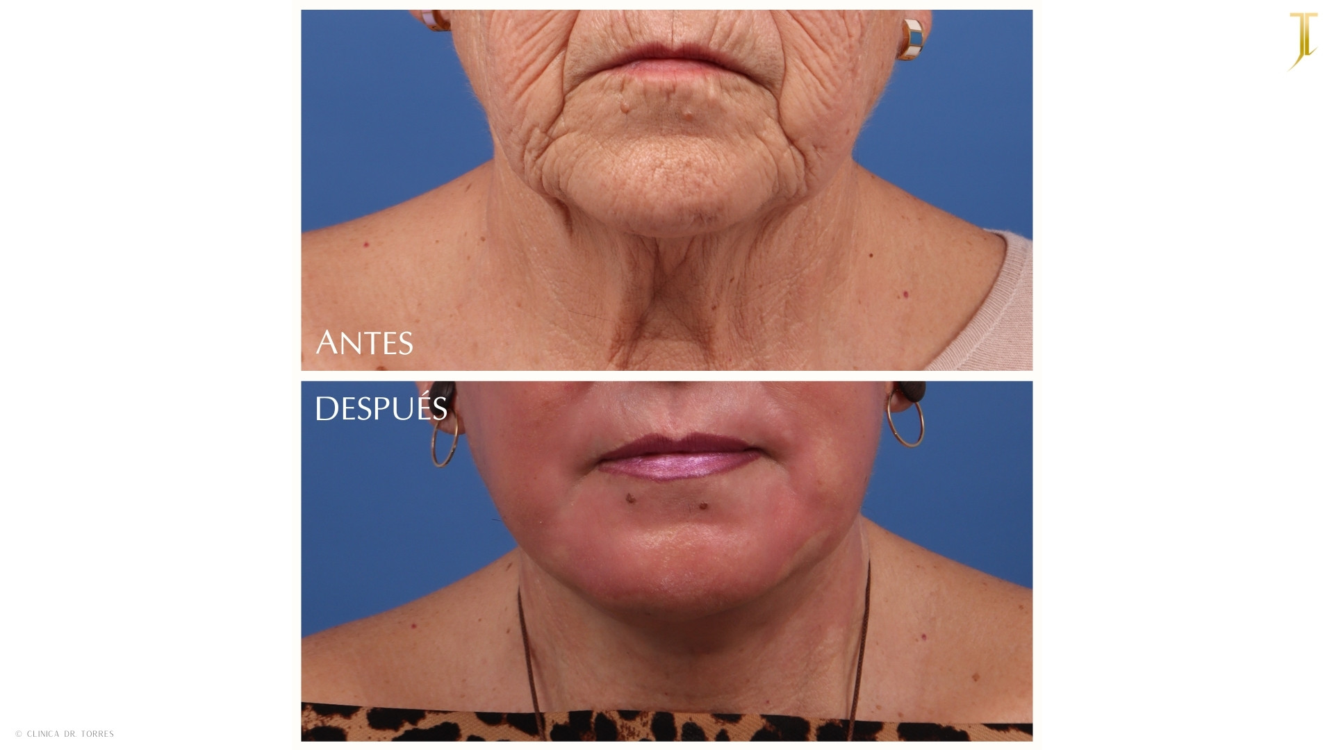 Peeling Profundo. Medicina y Cirugía Estética Facial y Corporal en Valencia Dr. Jorge Torres