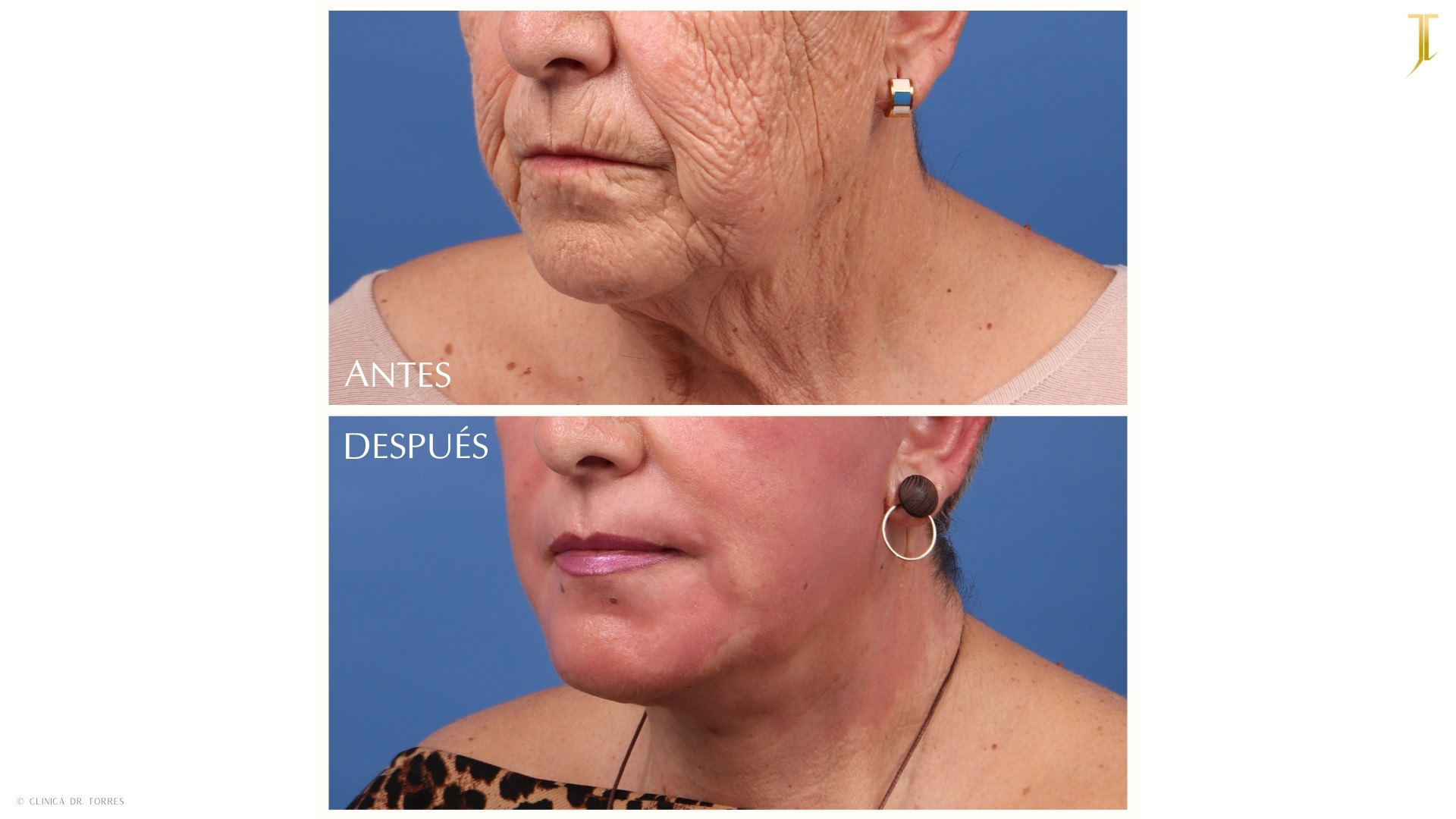 LIFTING FACIAL + Peeling Profundo. Medicina y Cirugía Estética Facial y Corporal en Valencia Dr. Jorge Torres