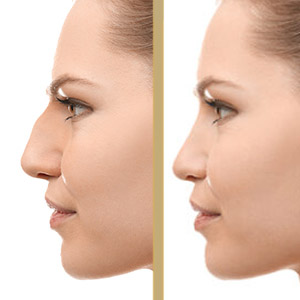 La rinoplastia o cirugía de la nariz