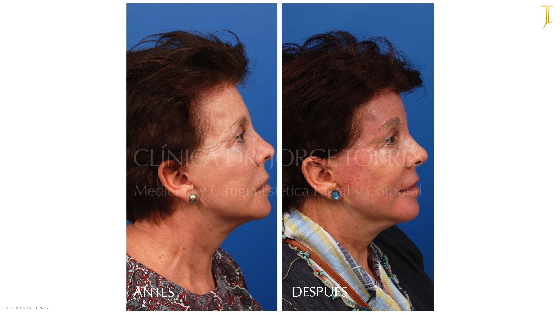 Peeling Profundo. Medicina y Cirugía Estética Facial y Corporal en Valencia Dr. Jorge Torres