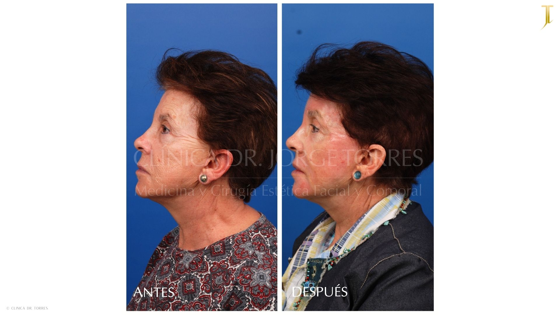 Peeling Profundo. Medicina y Cirugía Estética Facial y Corporal en Valencia Dr. Jorge Torres