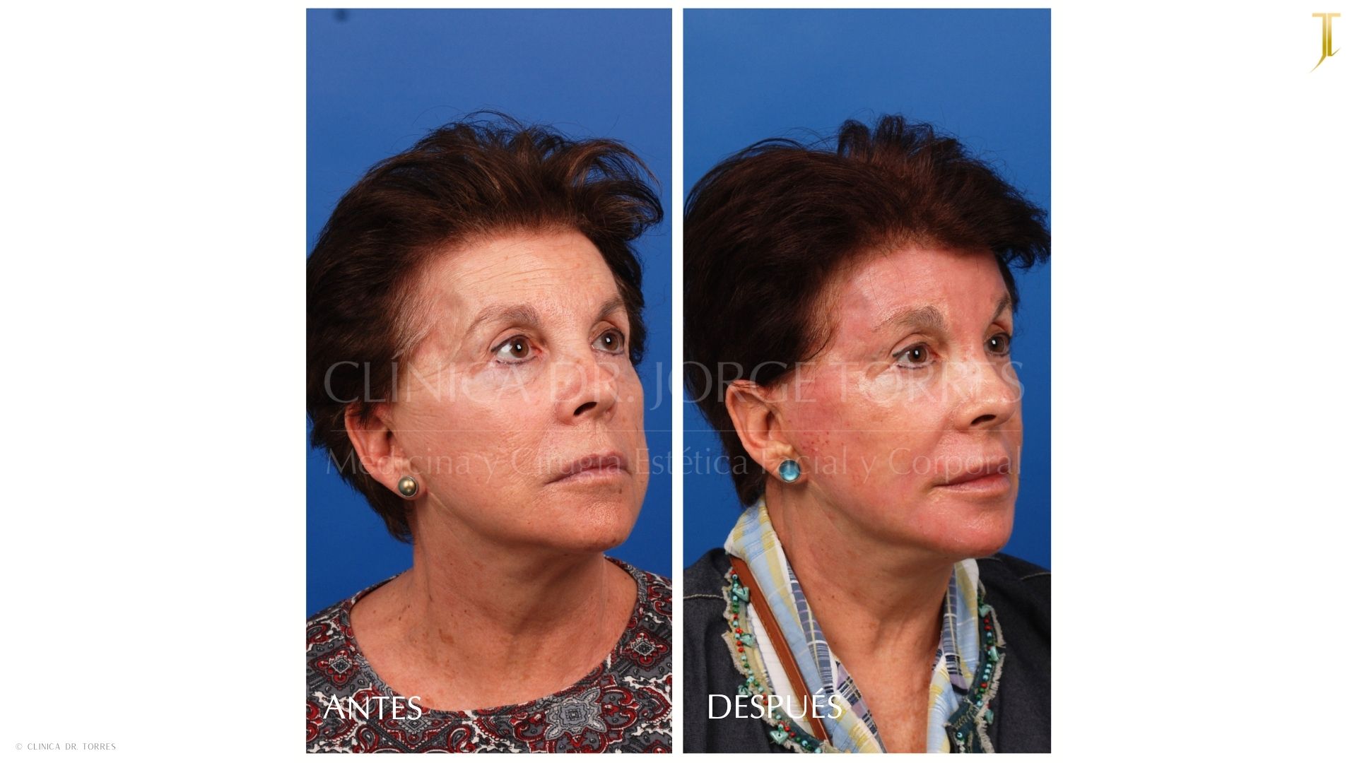 Peeling Profundo. Medicina y Cirugía Estética Facial y Corporal en Valencia Dr. Jorge Torres