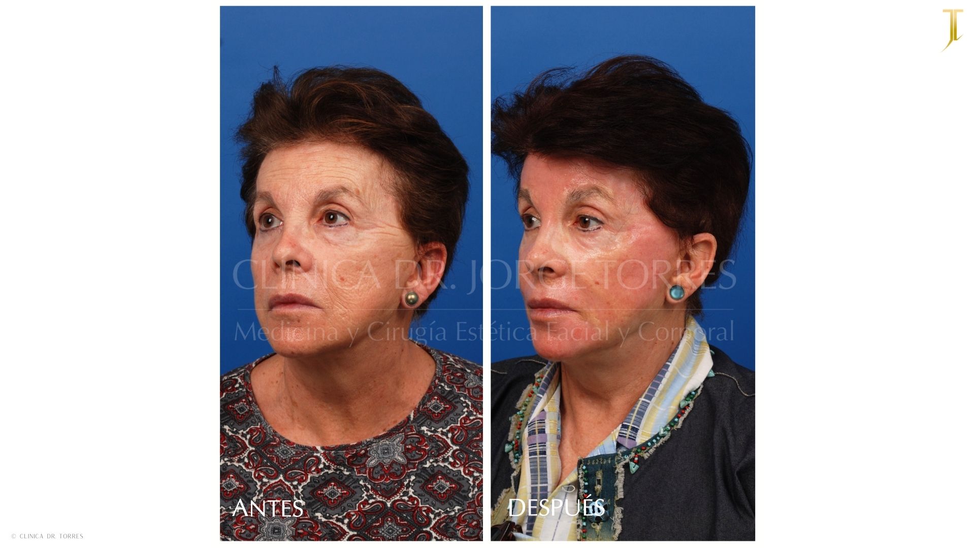 Peeling Profundo. Medicina y Cirugía Estética Facial y Corporal en Valencia Dr. Jorge Torres
