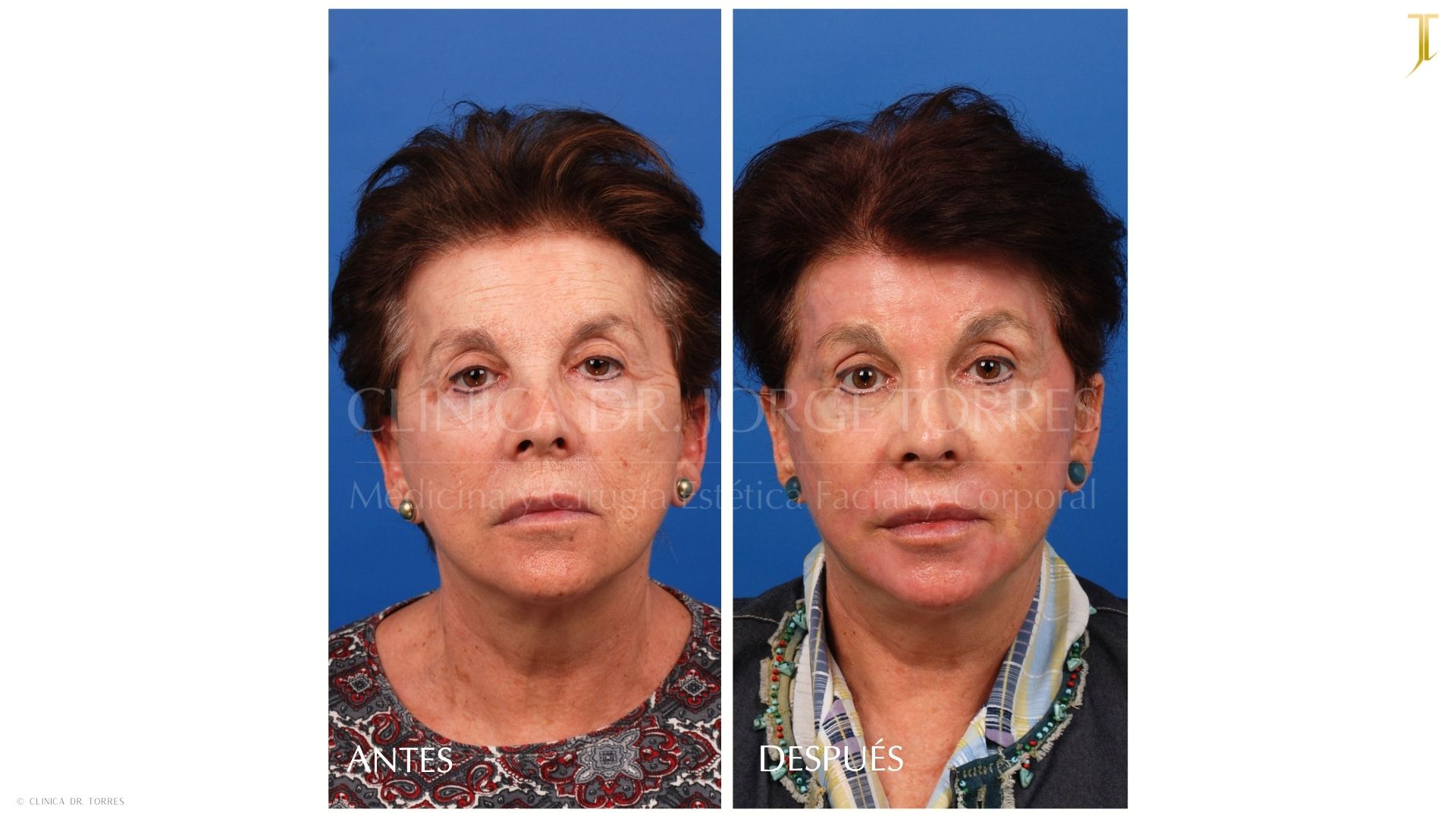 Peeling Profundo. Medicina y Cirugía Estética Facial y Corporal en Valencia Dr. Jorge Torres