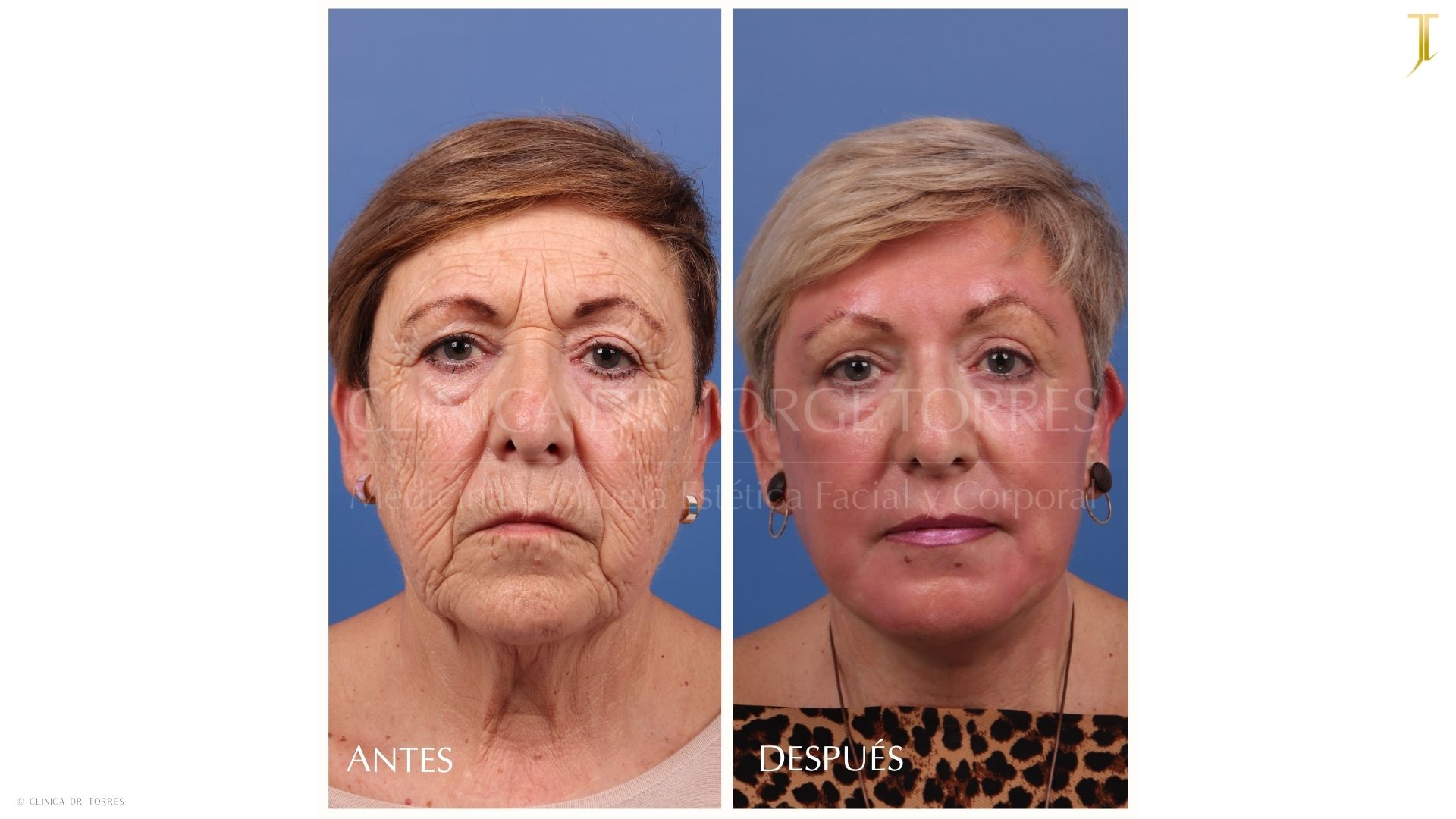 Peeling Profundo. Medicina y Cirugía Estética Facial y Corporal en Valencia Dr. Jorge Torres