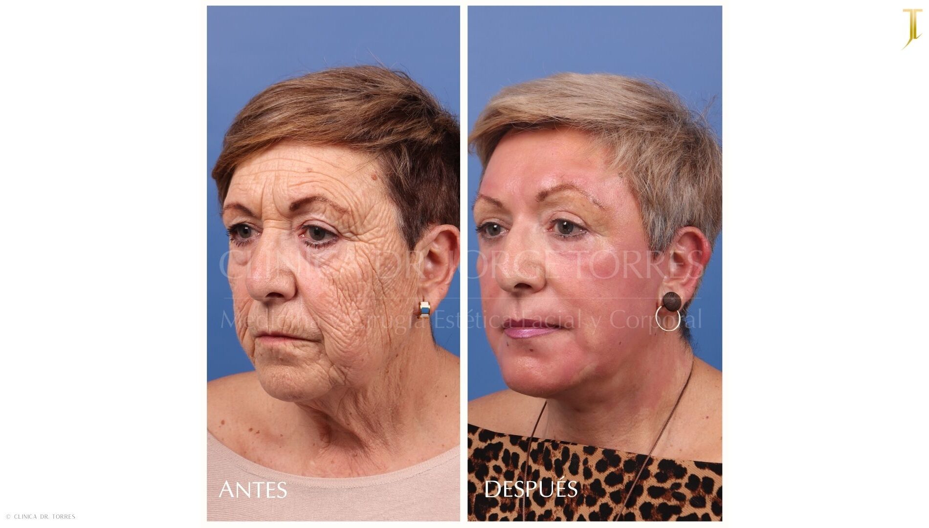 Peeling Profundo. Medicina y Cirugía Estética Facial y Corporal en Valencia Dr. Jorge Torres