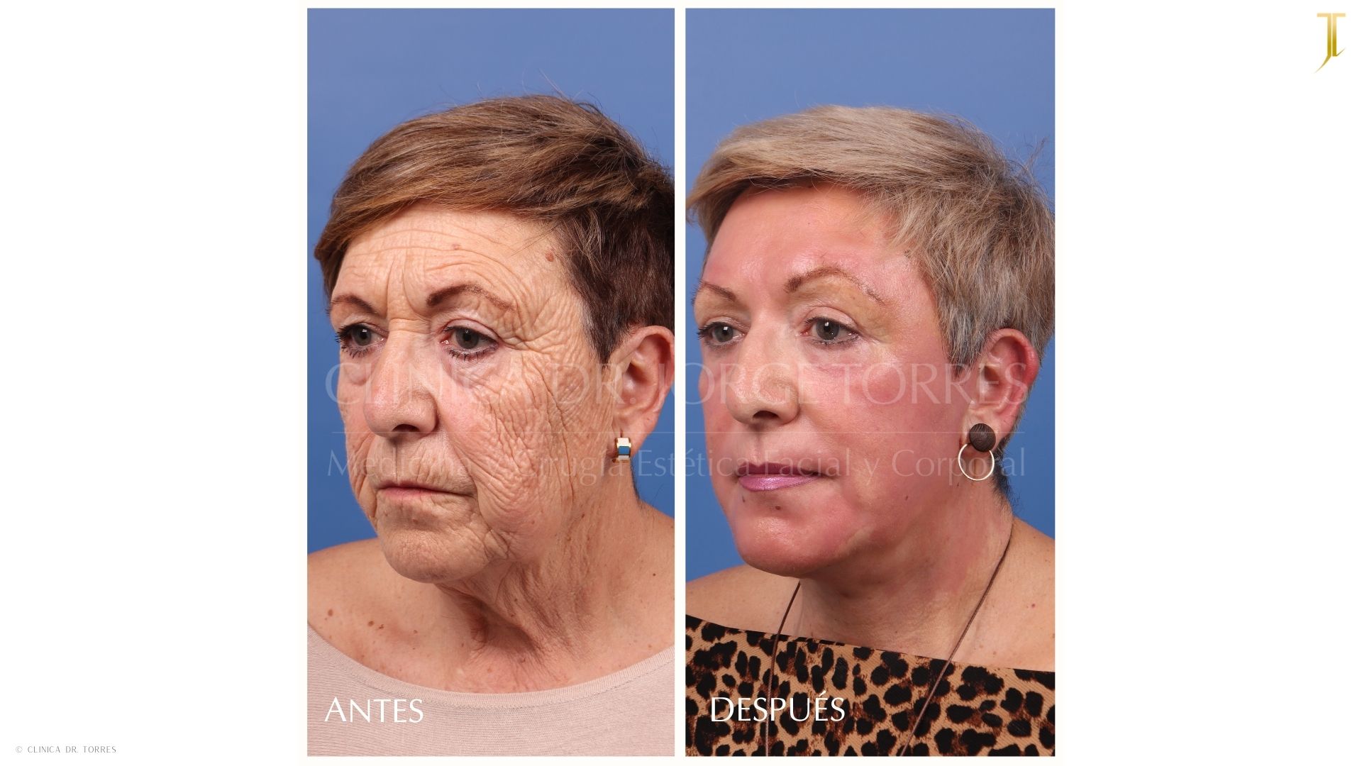 Peeling Profundo. Medicina y Cirugía Estética Facial y Corporal en Valencia Dr. Jorge Torres