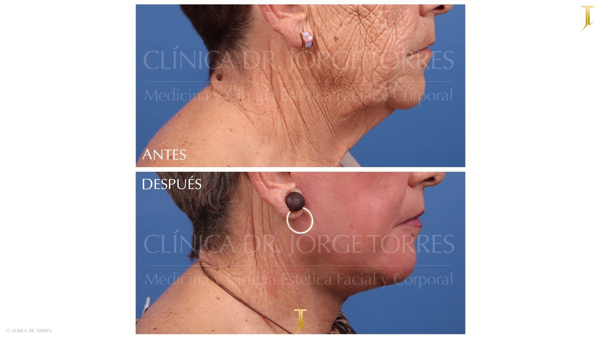 Peeling Profundo. Medicina y Cirugía Estética Facial y Corporal en Valencia Dr. Jorge Torres
