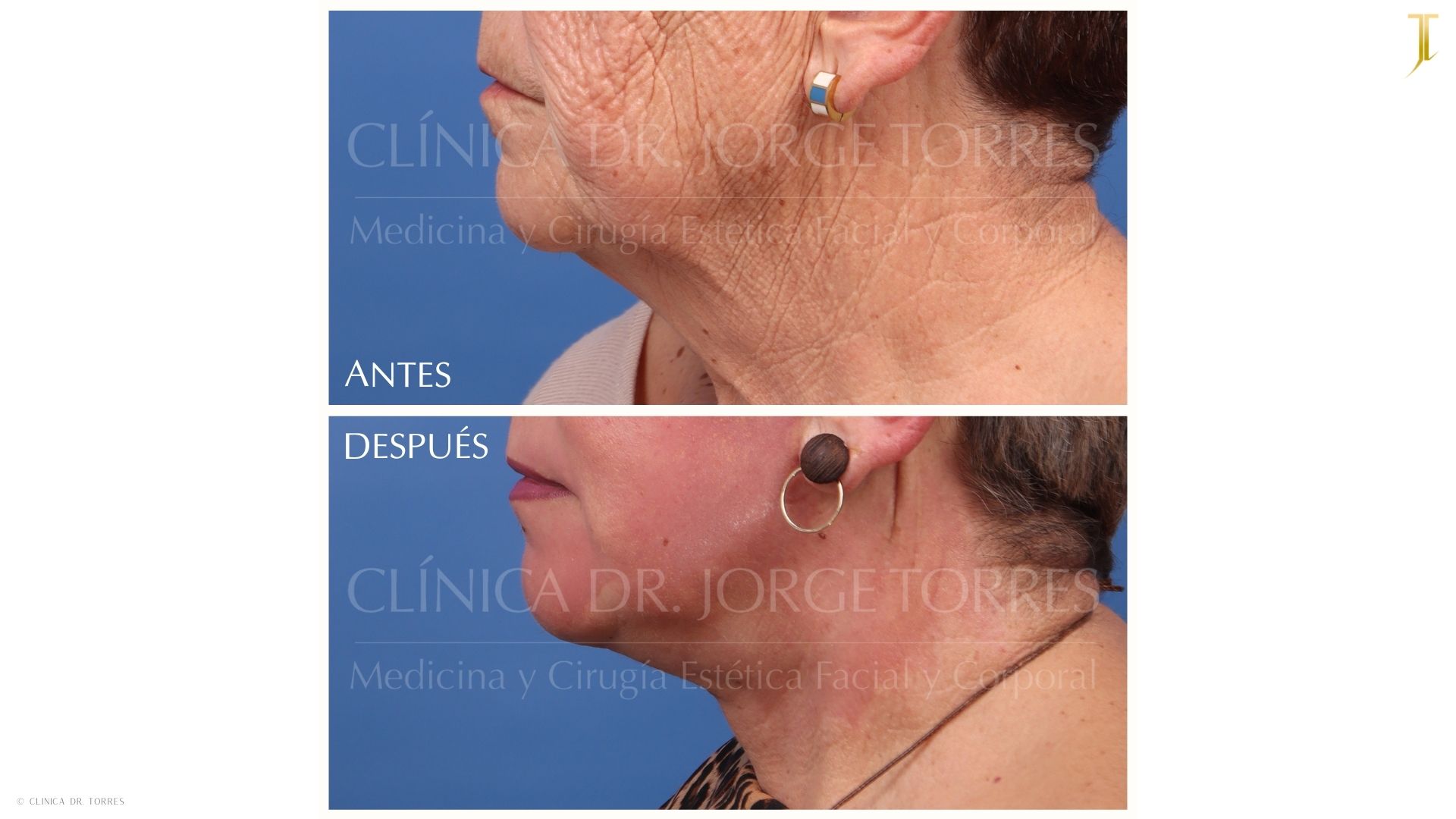 Peeling Profundo. Medicina y Cirugía Estética Facial y Corporal en Valencia Dr. Jorge Torres