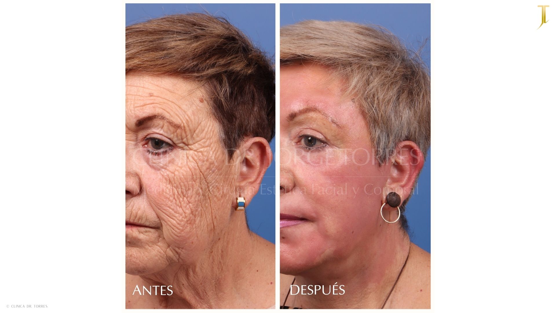 Peeling Profundo. Medicina y Cirugía Estética Facial y Corporal en Valencia Dr. Jorge Torres