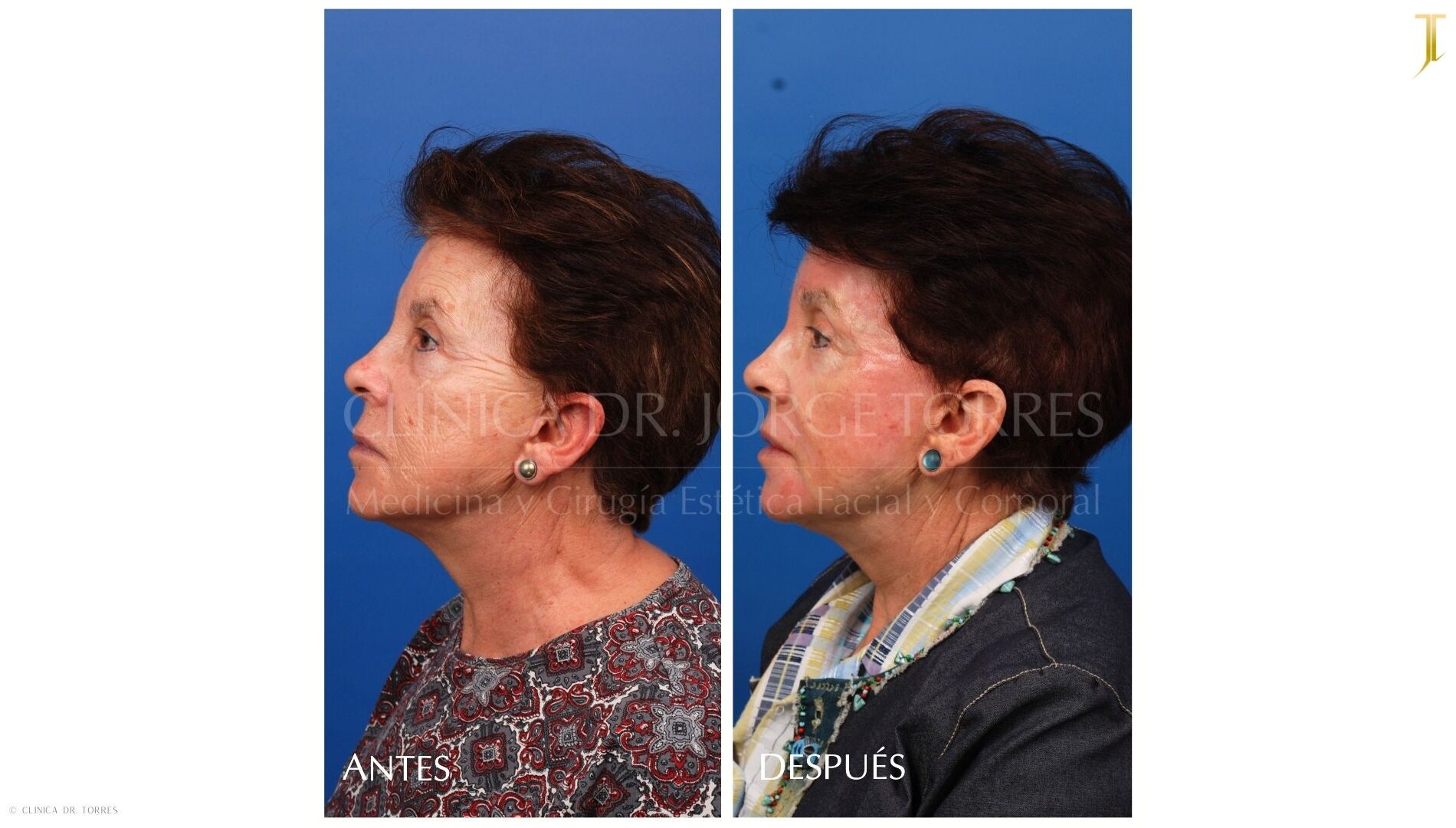 Peeling Profundo. Medicina y Cirugía Estética Facial y Corporal en Valencia Dr. Jorge Torres