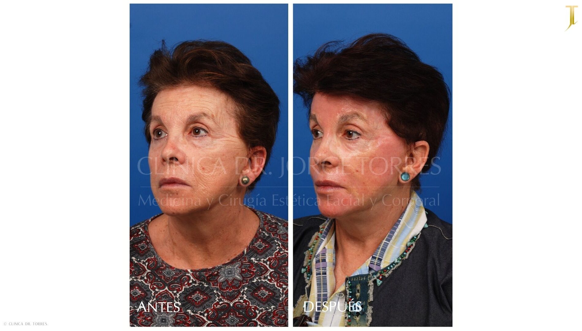 Peeling Profundo. Medicina y Cirugía Estética Facial y Corporal en Valencia Dr. Jorge Torres