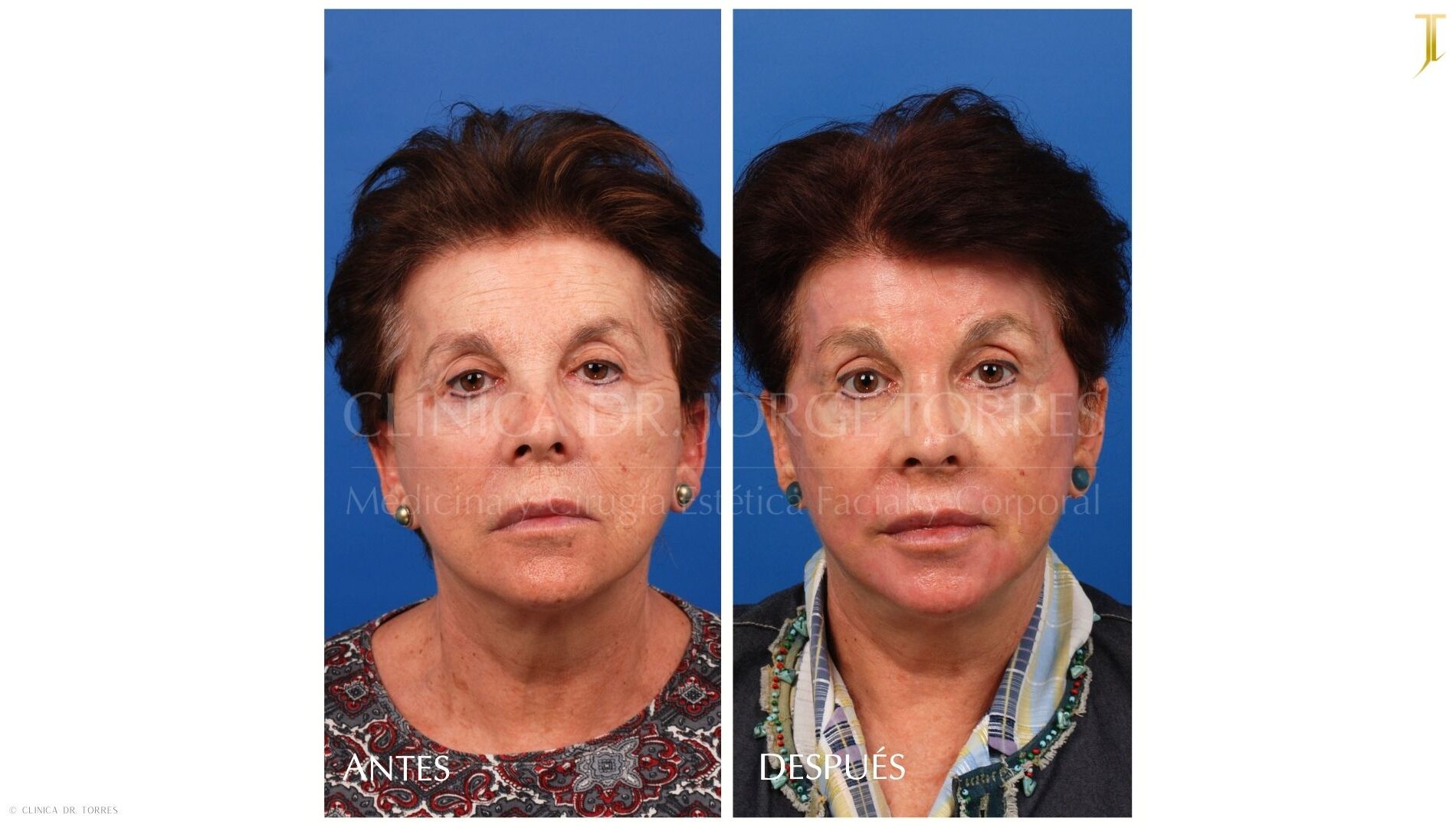 Peeling Profundo. Medicina y Cirugía Estética Facial y Corporal en Valencia Dr. Jorge Torres