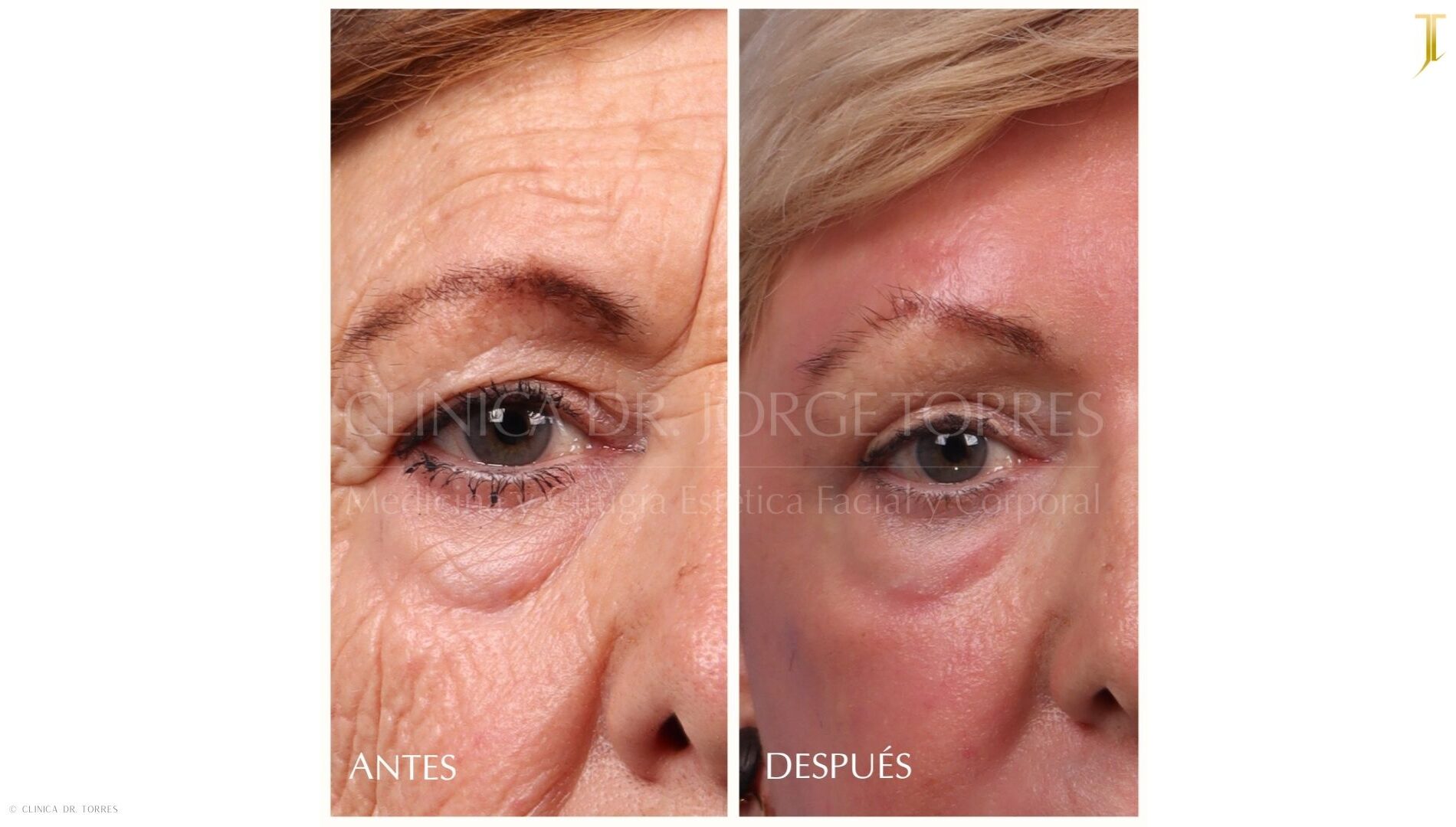 Peeling Profundo. Medicina y Cirugía Estética Facial y Corporal en Valencia Dr. Jorge Torres