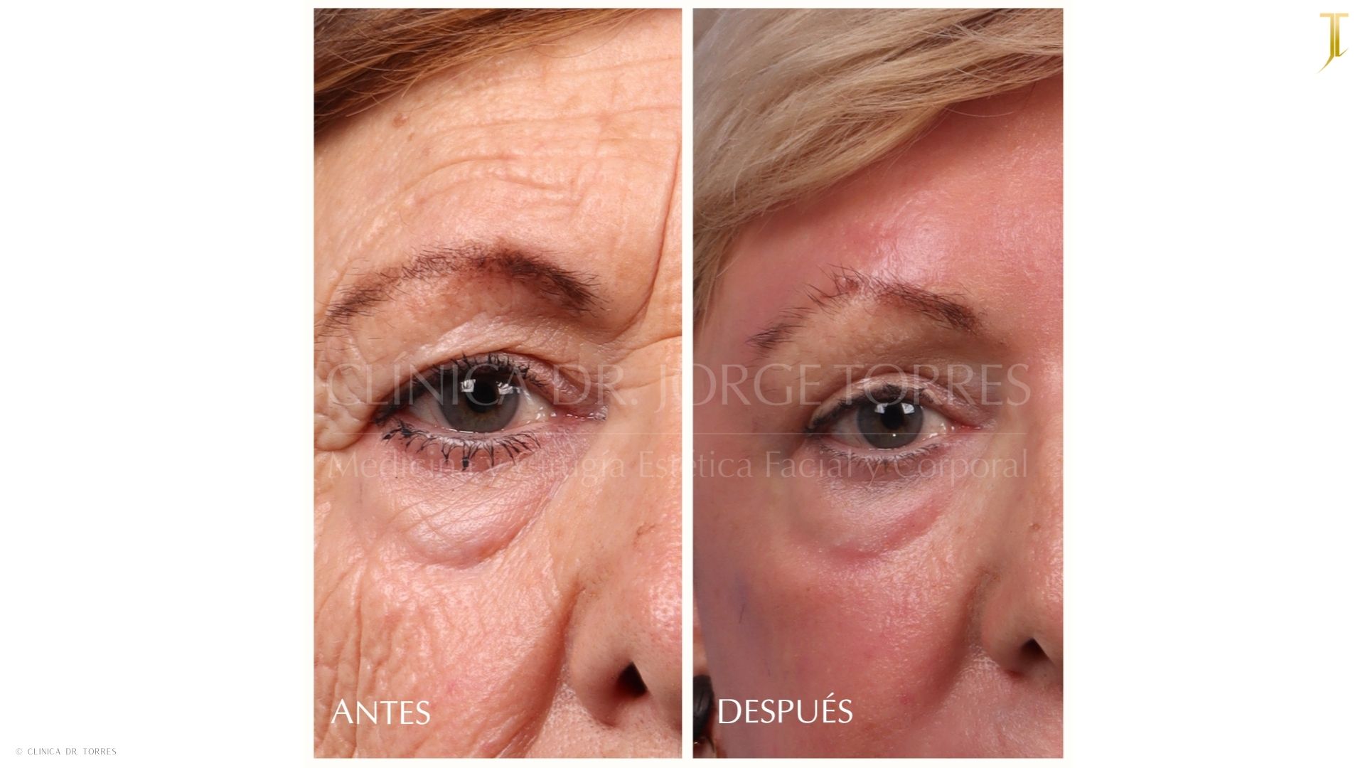 Peeling Profundo. Medicina y Cirugía Estética Facial y Corporal en Valencia Dr. Jorge Torres