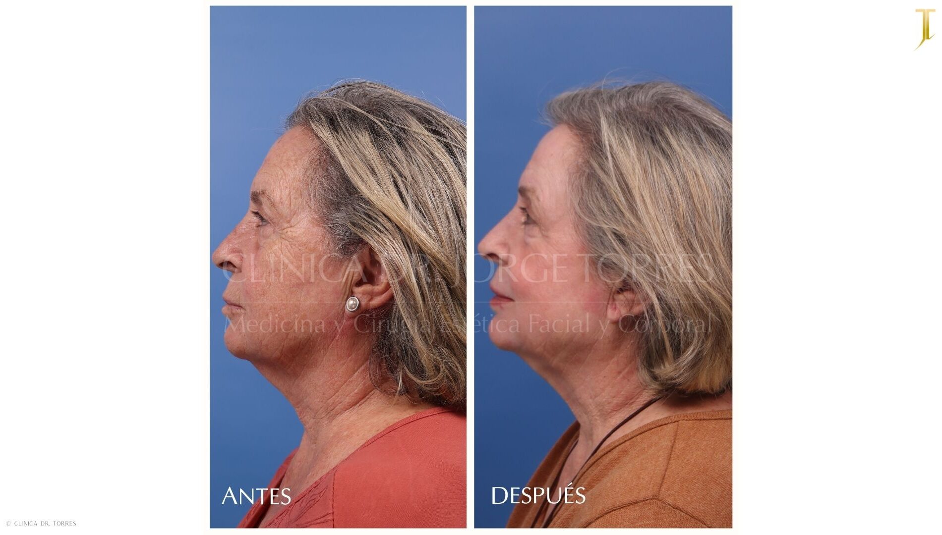 Peeling Profundo. Medicina y Cirugía Estética Facial y Corporal en Valencia Dr. Jorge Torres