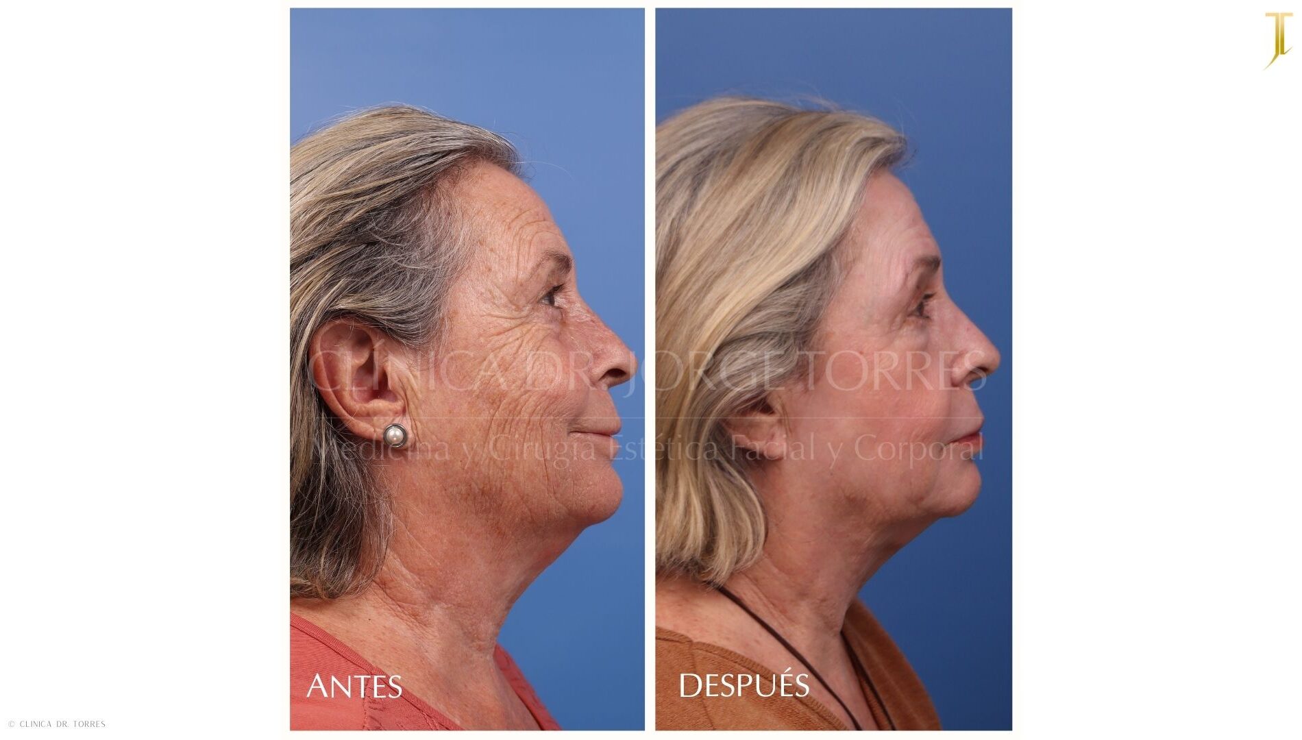 Peeling Profundo. Medicina y Cirugía Estética Facial y Corporal en Valencia Dr. Jorge Torres