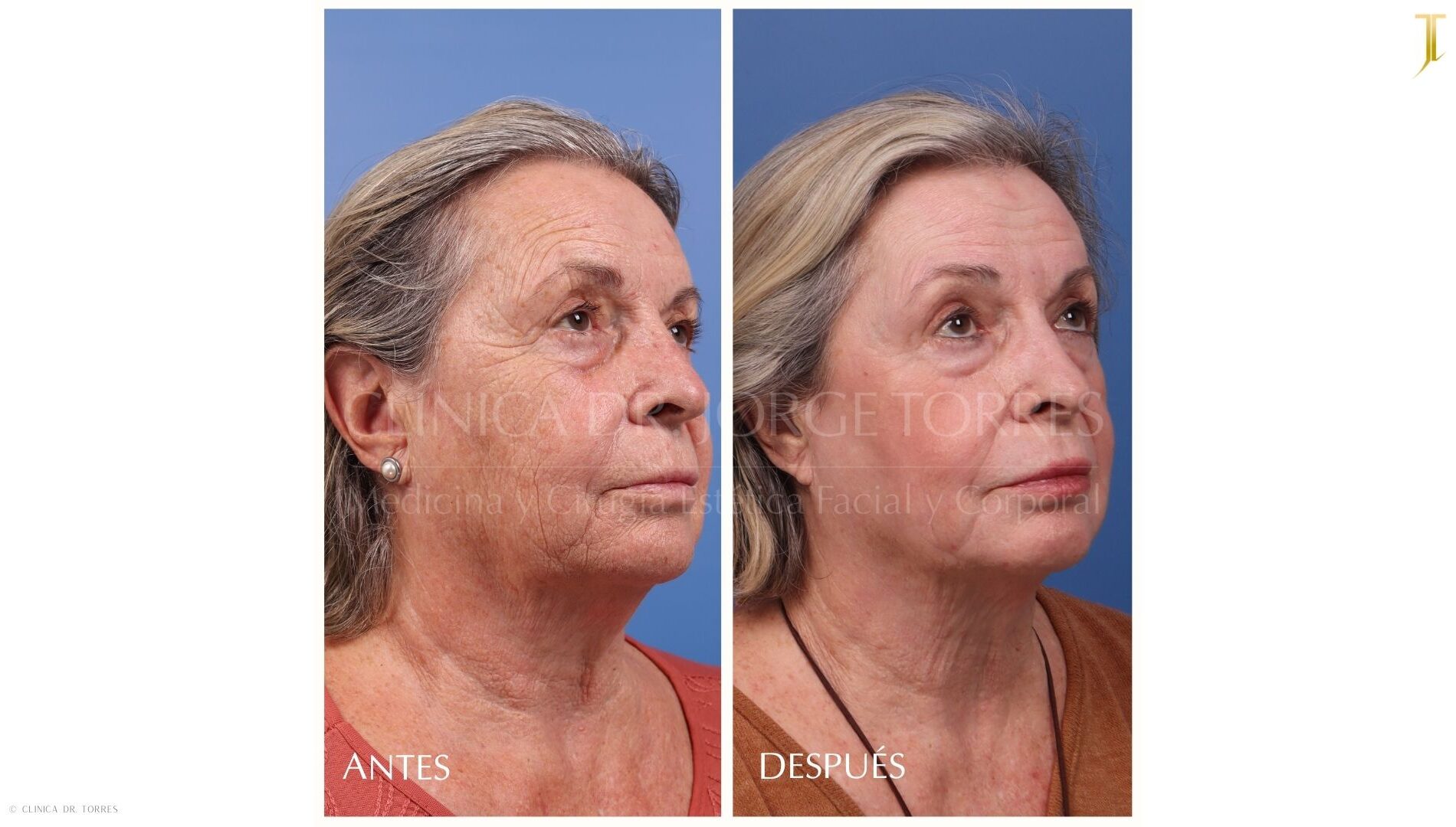 Peeling Profundo. Medicina y Cirugía Estética Facial y Corporal en Valencia Dr. Jorge Torres