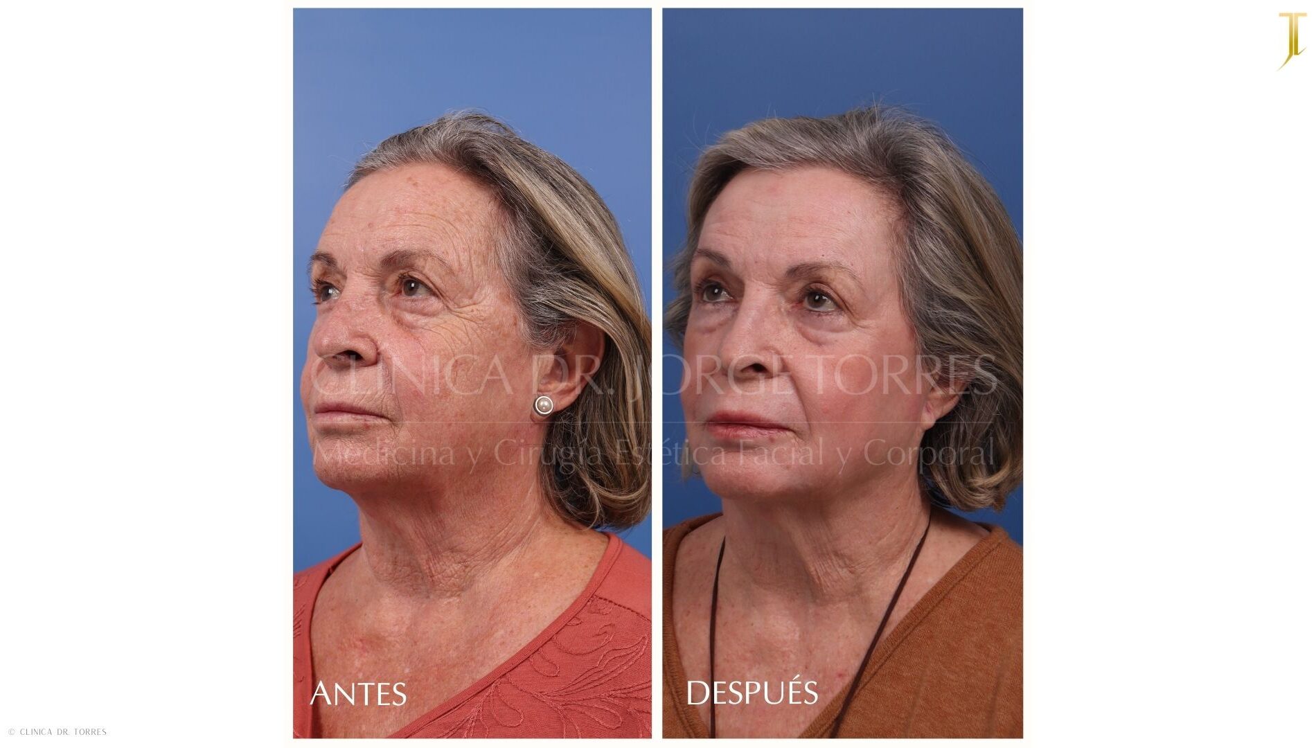 Peeling Profundo. Medicina y Cirugía Estética Facial y Corporal en Valencia Dr. Jorge Torres