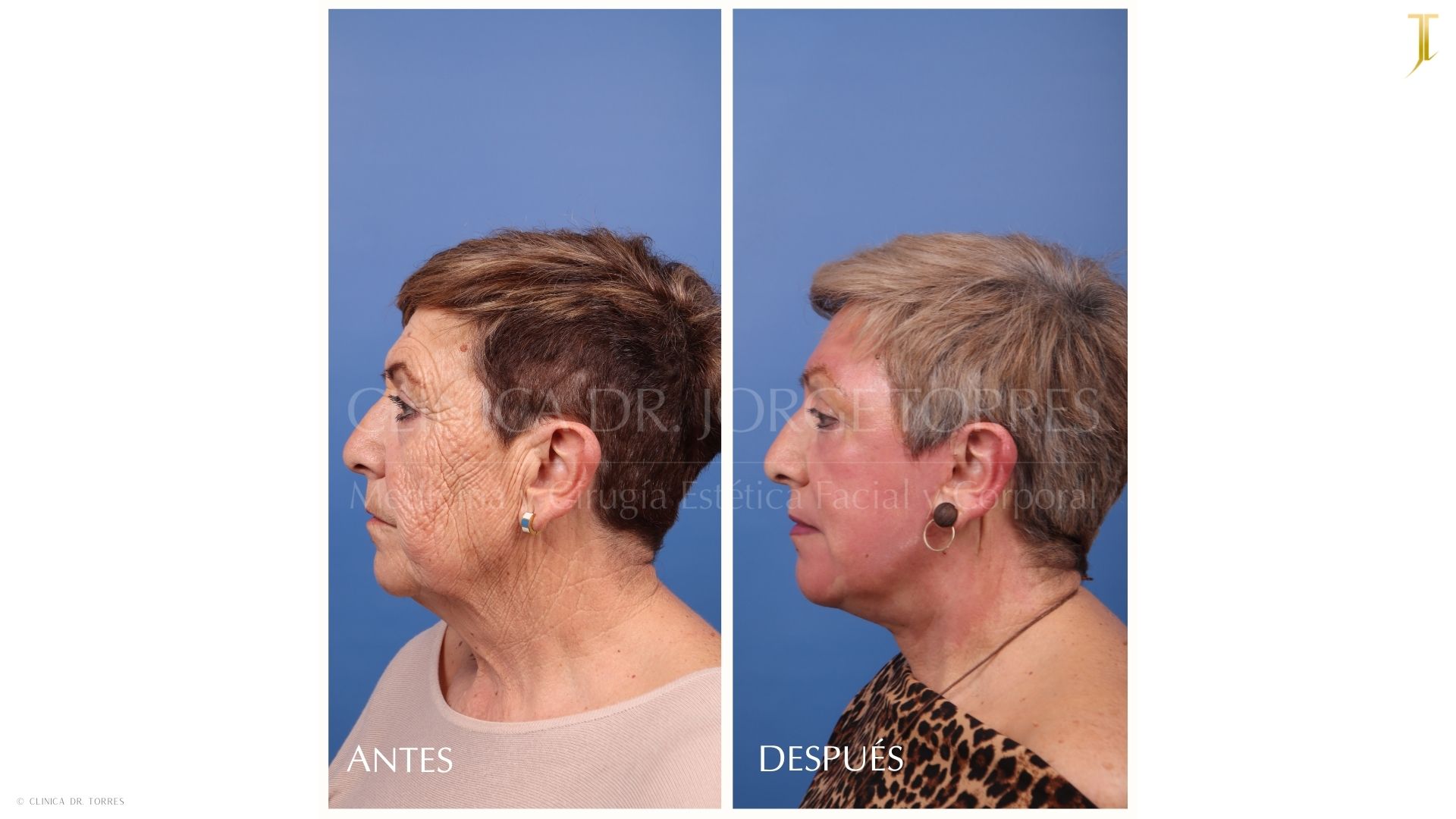 Peeling Profundo. Medicina y Cirugía Estética Facial y Corporal en Valencia Dr. Jorge Torres