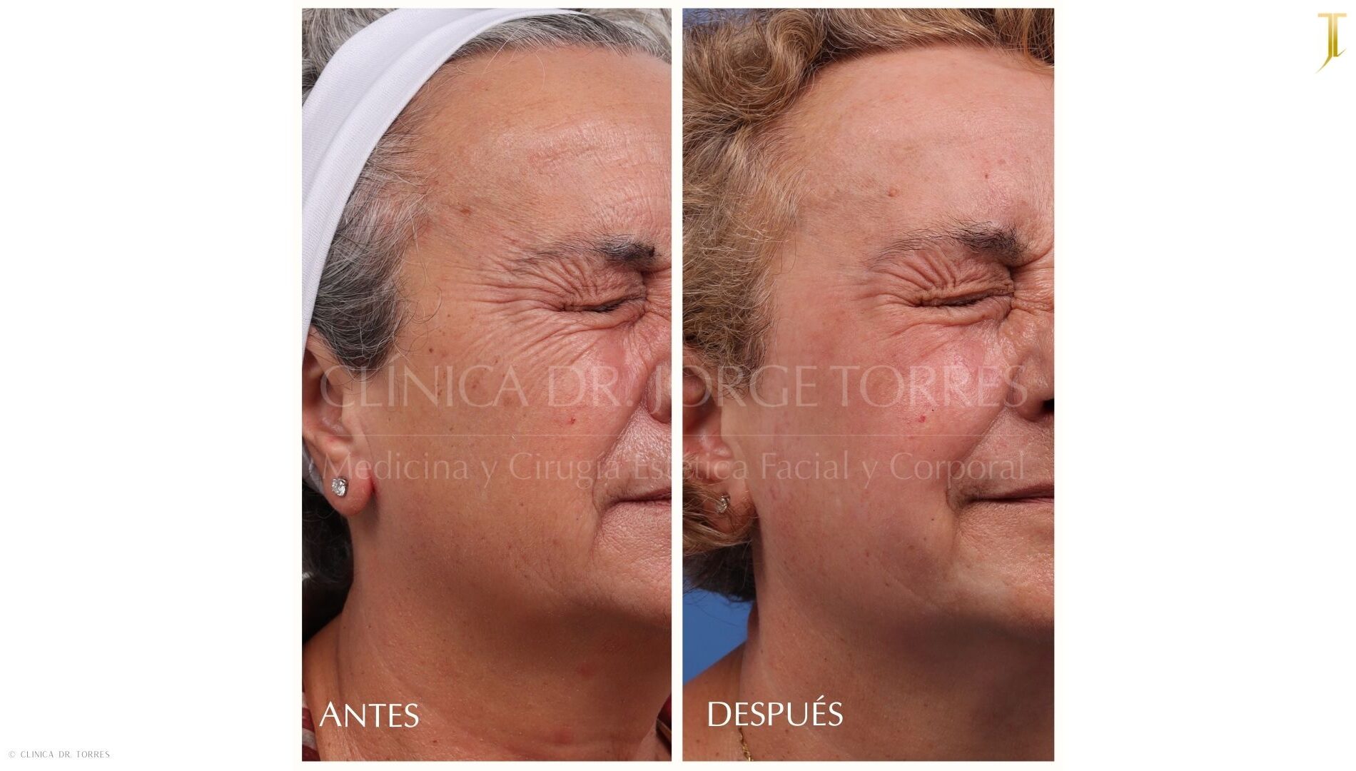 Peeling Profundo. Medicina y Cirugía Estética Facial y Corporal en Valencia Dr. Jorge Torres