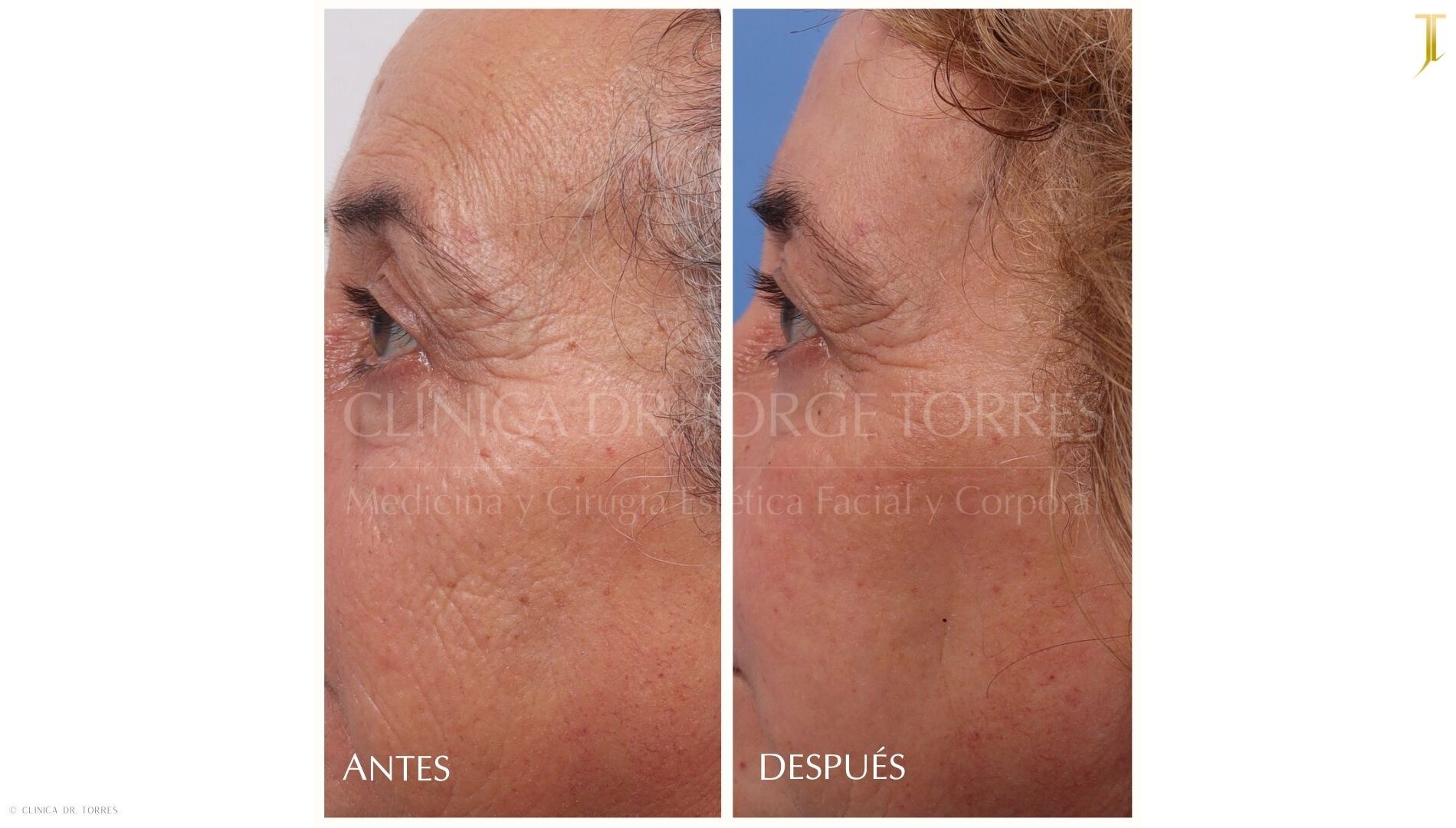 Peeling Profundo. Medicina y Cirugía Estética Facial y Corporal en Valencia Dr. Jorge Torres