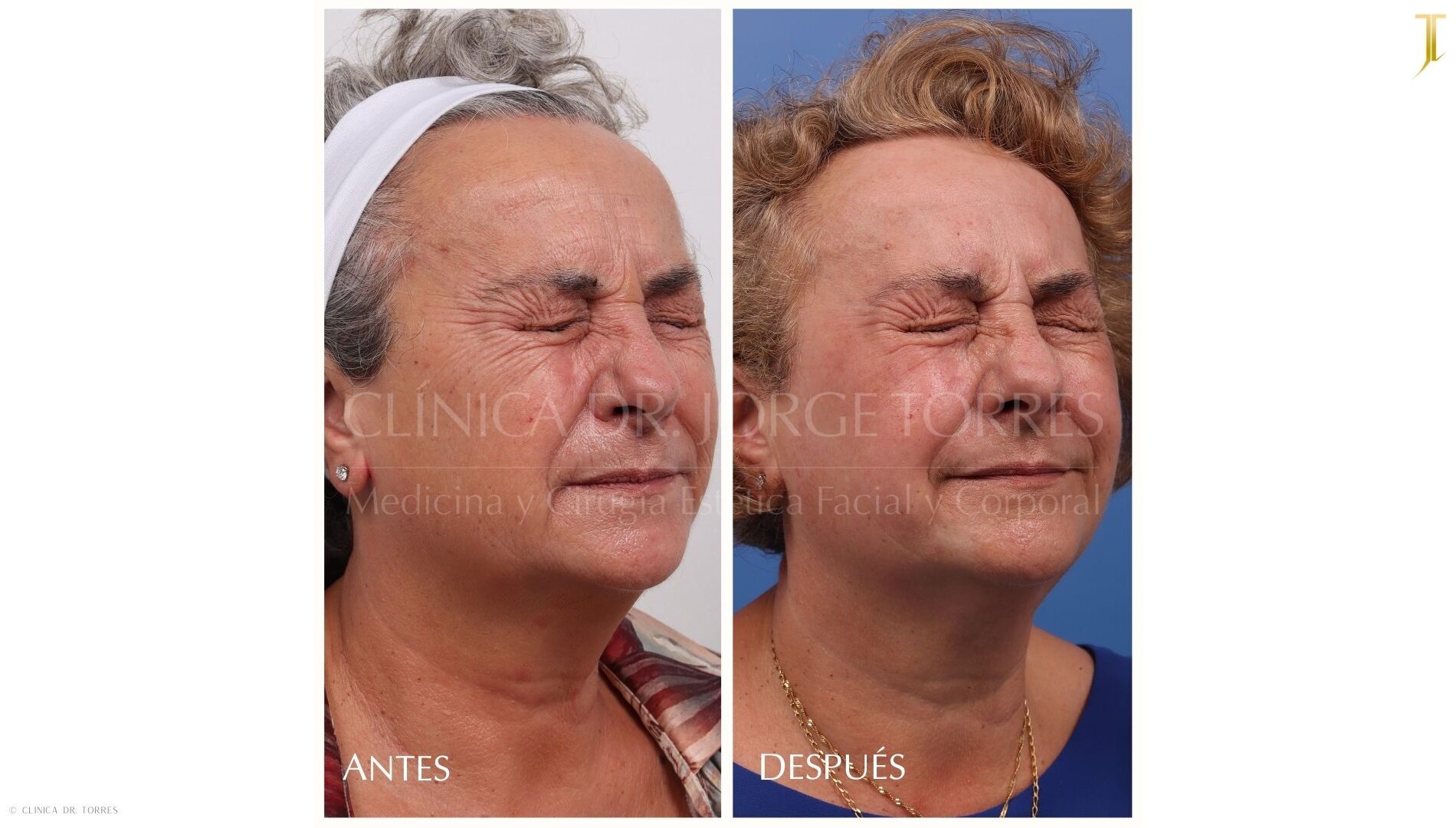 Peeling Profundo. Medicina y Cirugía Estética Facial y Corporal en Valencia Dr. Jorge Torres