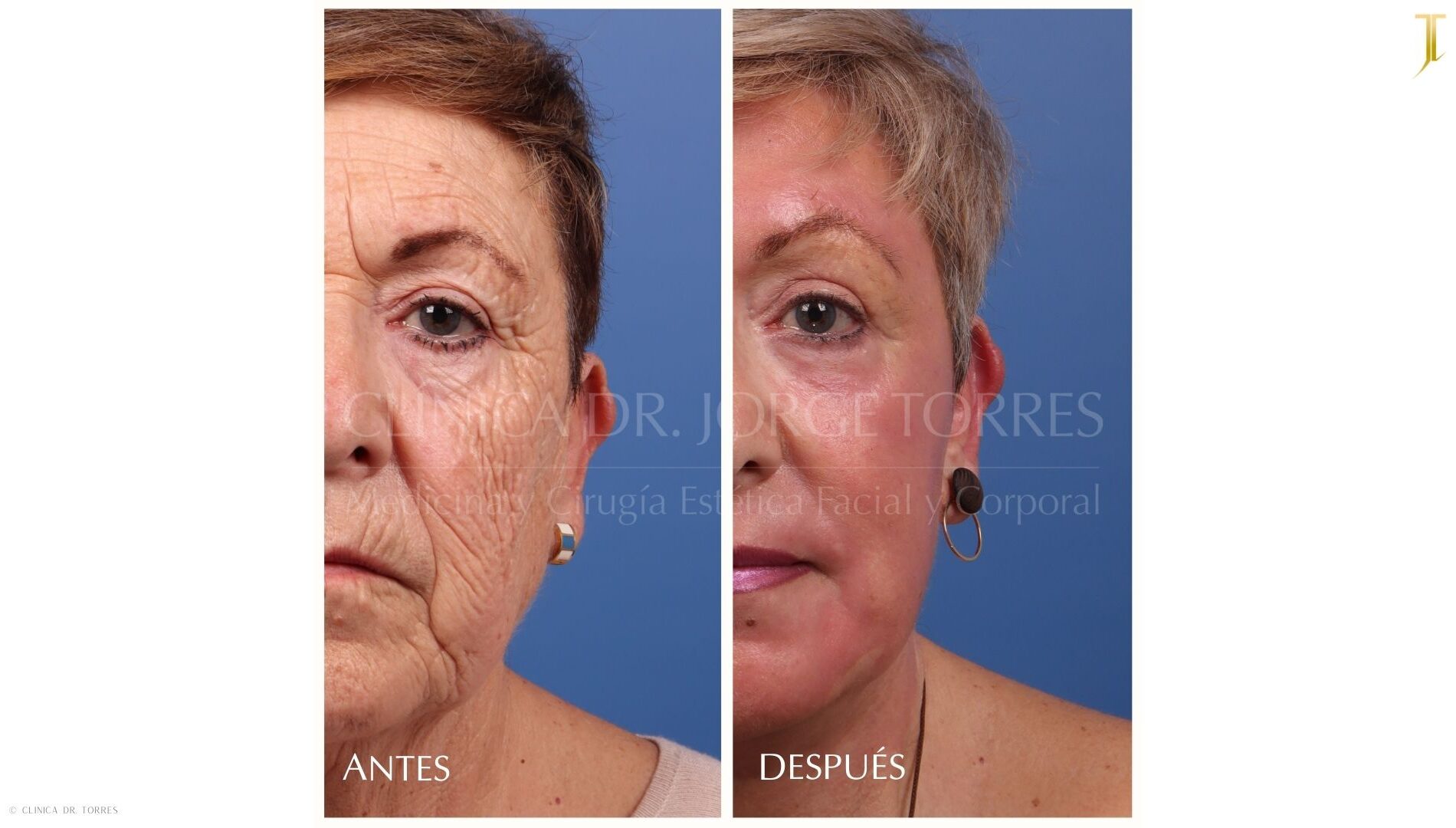 Peeling Profundo. Medicina y Cirugía Estética Facial y Corporal en Valencia Dr. Jorge Torres