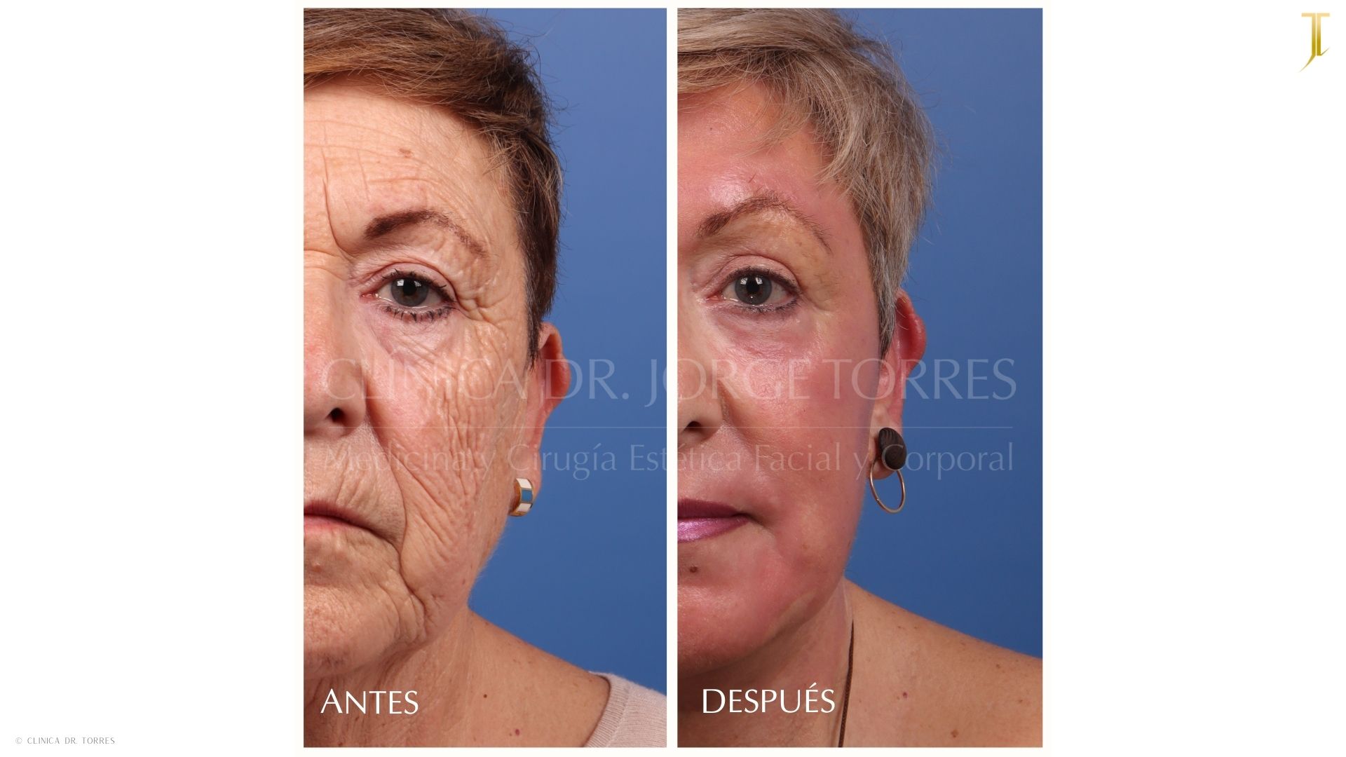 Peeling Profundo. Medicina y Cirugía Estética Facial y Corporal en Valencia Dr. Jorge Torres