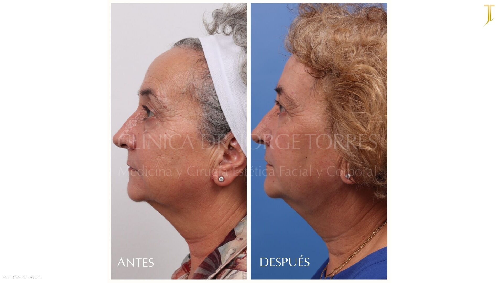 Peeling Profundo. Medicina y Cirugía Estética Facial y Corporal en Valencia Dr. Jorge Torres