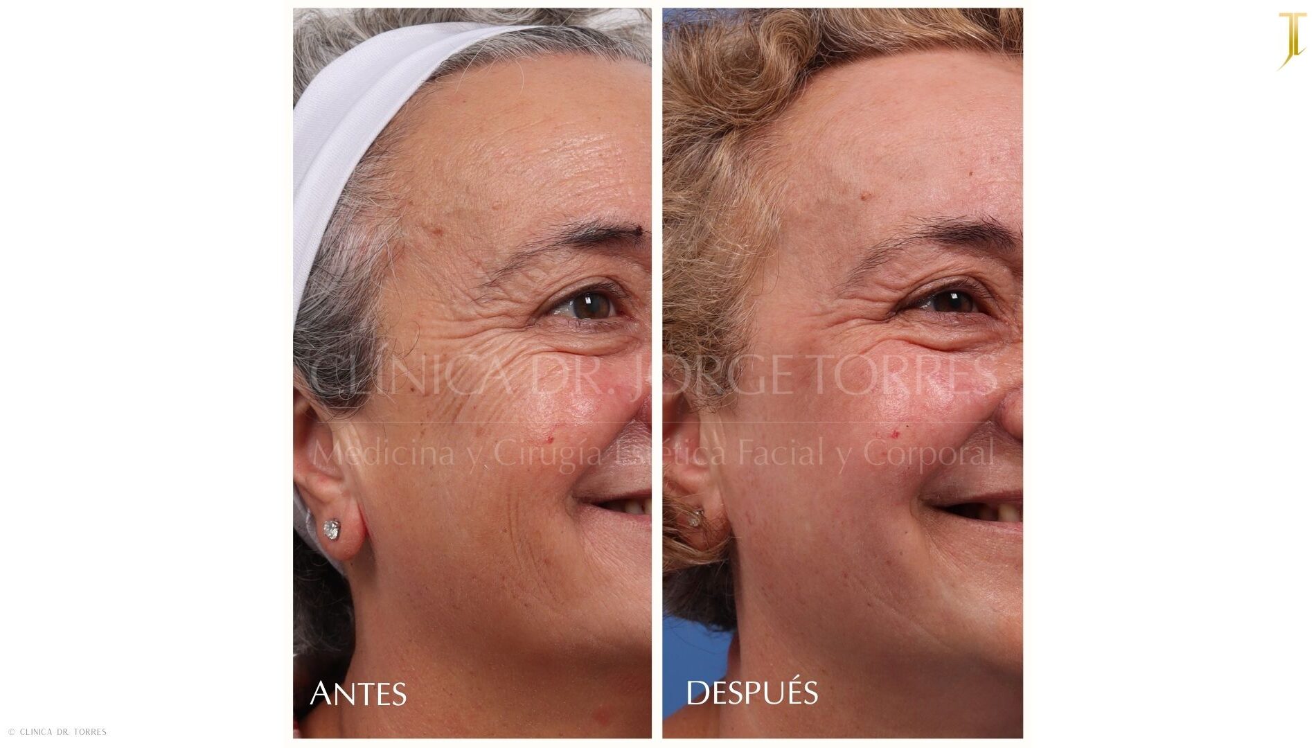 Peeling Profundo. Medicina y Cirugía Estética Facial y Corporal en Valencia Dr. Jorge Torres