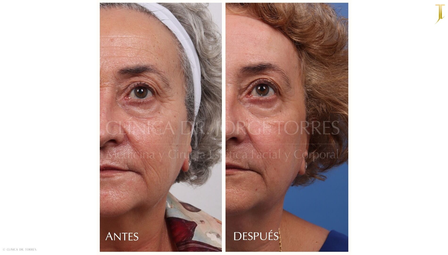Peeling Profundo. Medicina y Cirugía Estética Facial y Corporal en Valencia Dr. Jorge Torres