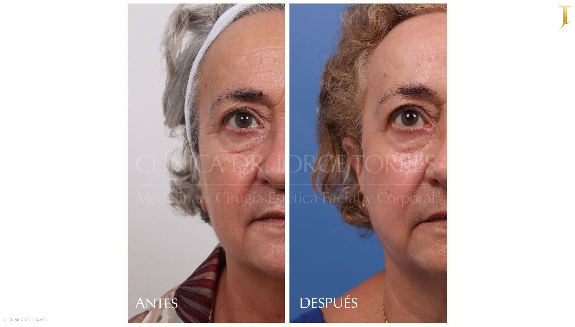 Peeling Profundo. Medicina y Cirugía Estética Facial y Corporal en Valencia Dr. Jorge Torres