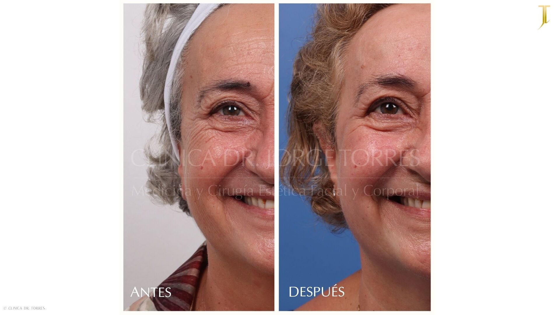 Peeling Profundo. Medicina y Cirugía Estética Facial y Corporal en Valencia Dr. Jorge Torres