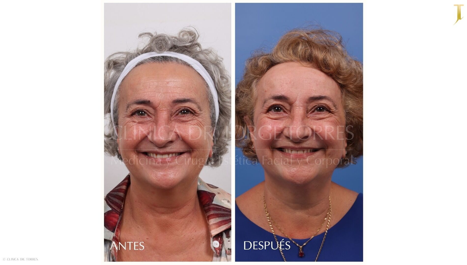 Peeling Profundo. Medicina y Cirugía Estética Facial y Corporal en Valencia Dr. Jorge Torres