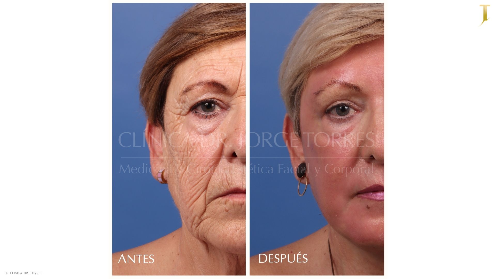 Peeling Profundo. Medicina y Cirugía Estética Facial y Corporal en Valencia Dr. Jorge Torres