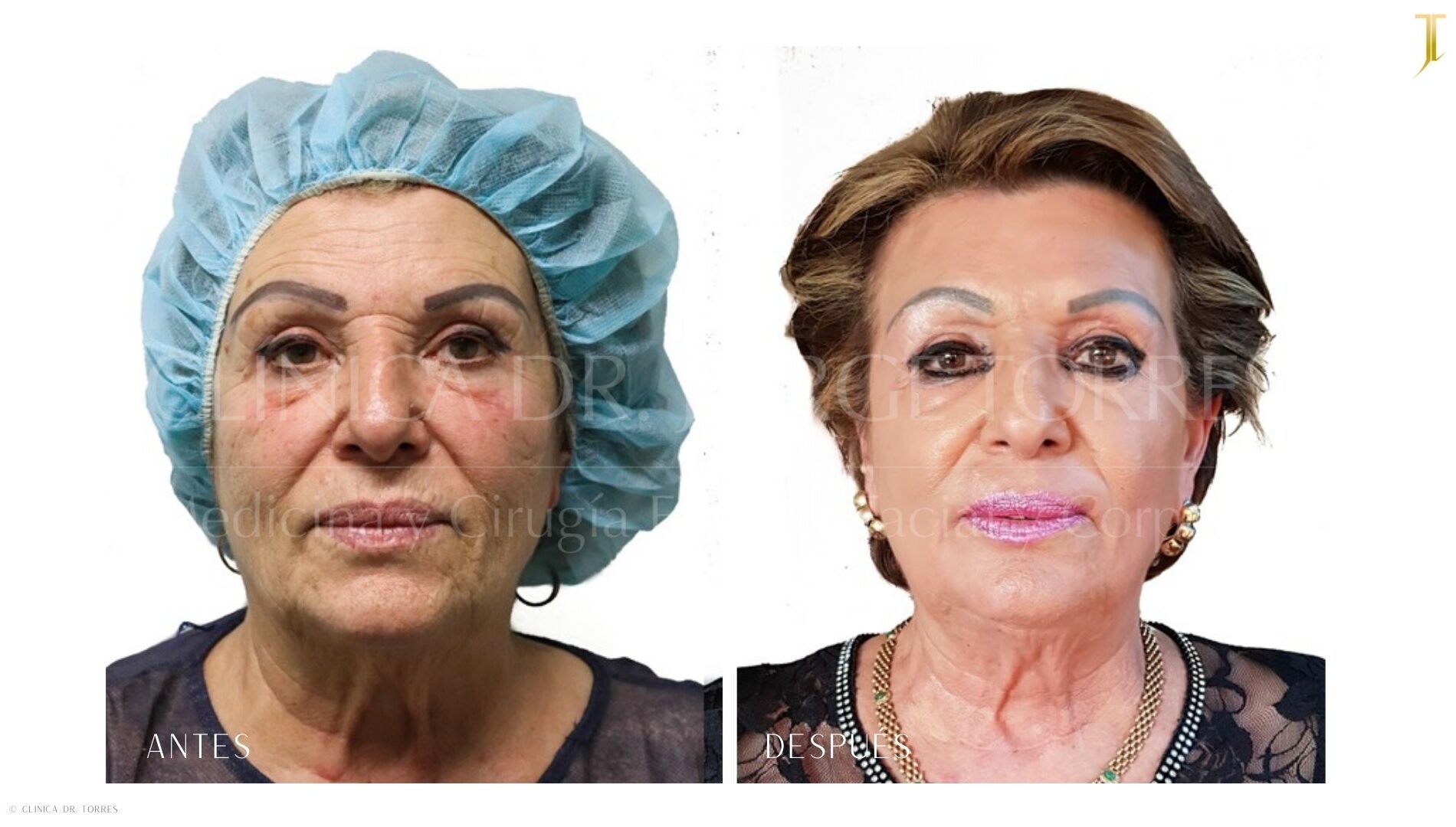 Peeling Profundo. Medicina y Cirugía Estética Facial y Corporal en Valencia Dr. Jorge Torres