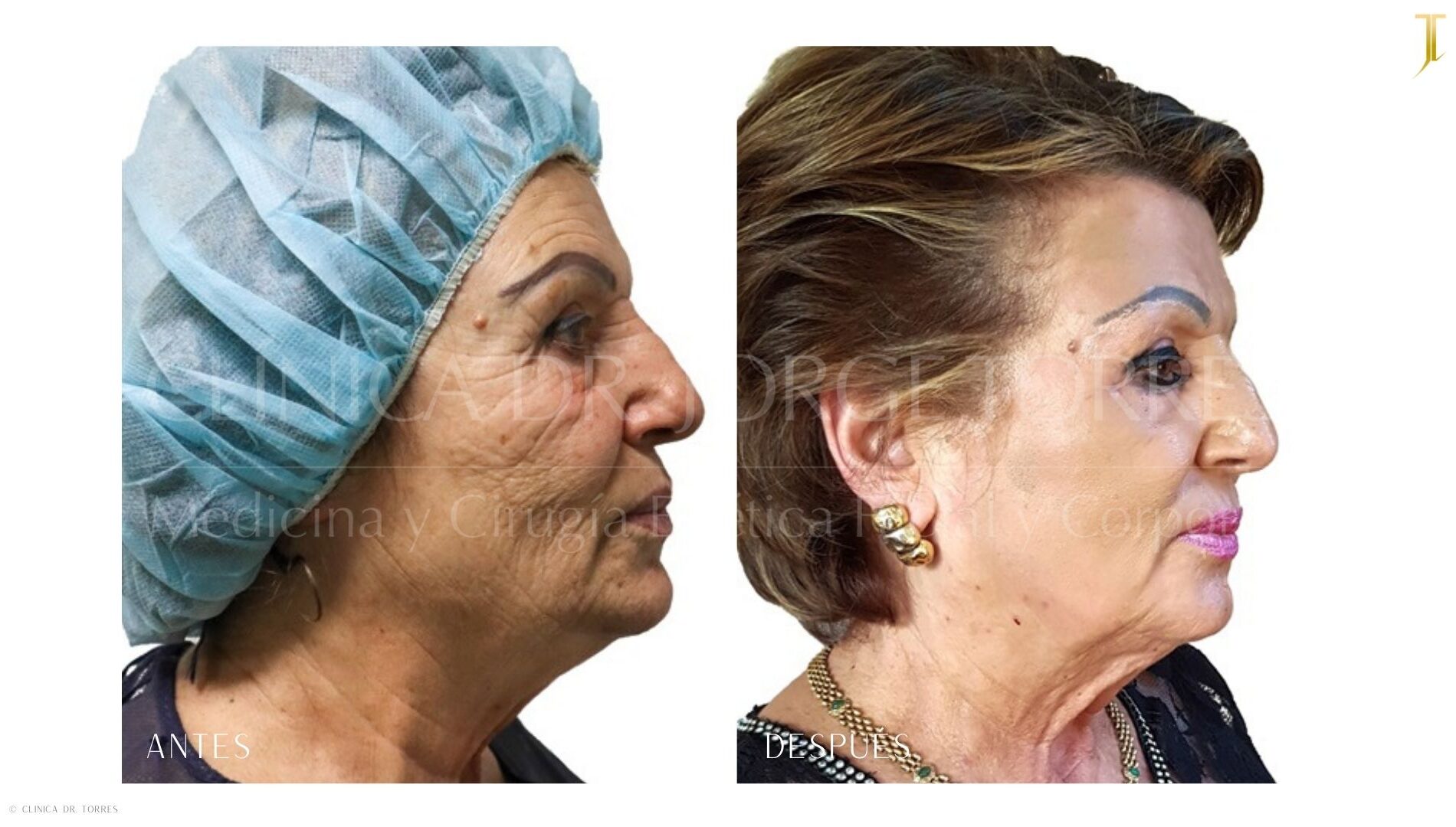 Peeling Profundo. Medicina y Cirugía Estética Facial y Corporal en Valencia Dr. Jorge Torres