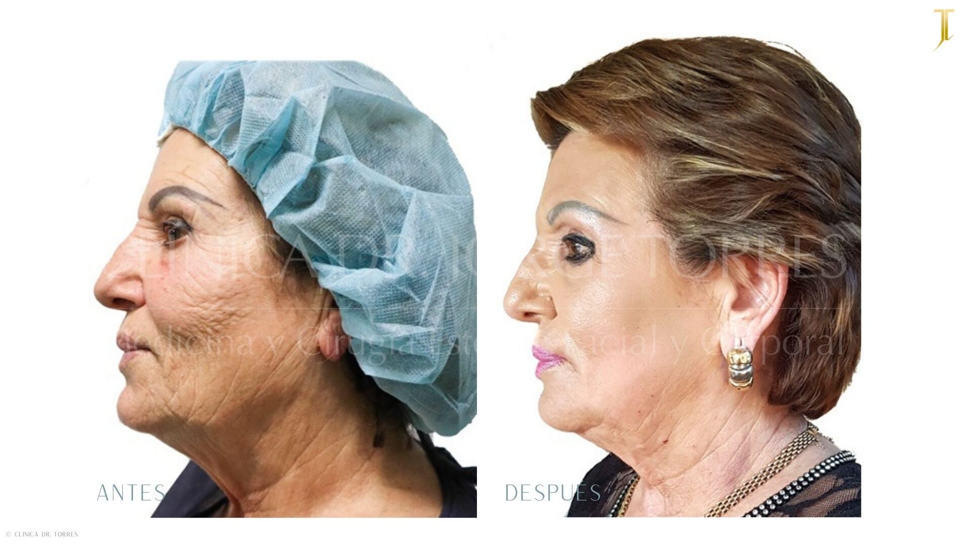 Peeling Profundo. Medicina y Cirugía Estética Facial y Corporal en Valencia Dr. Jorge Torres