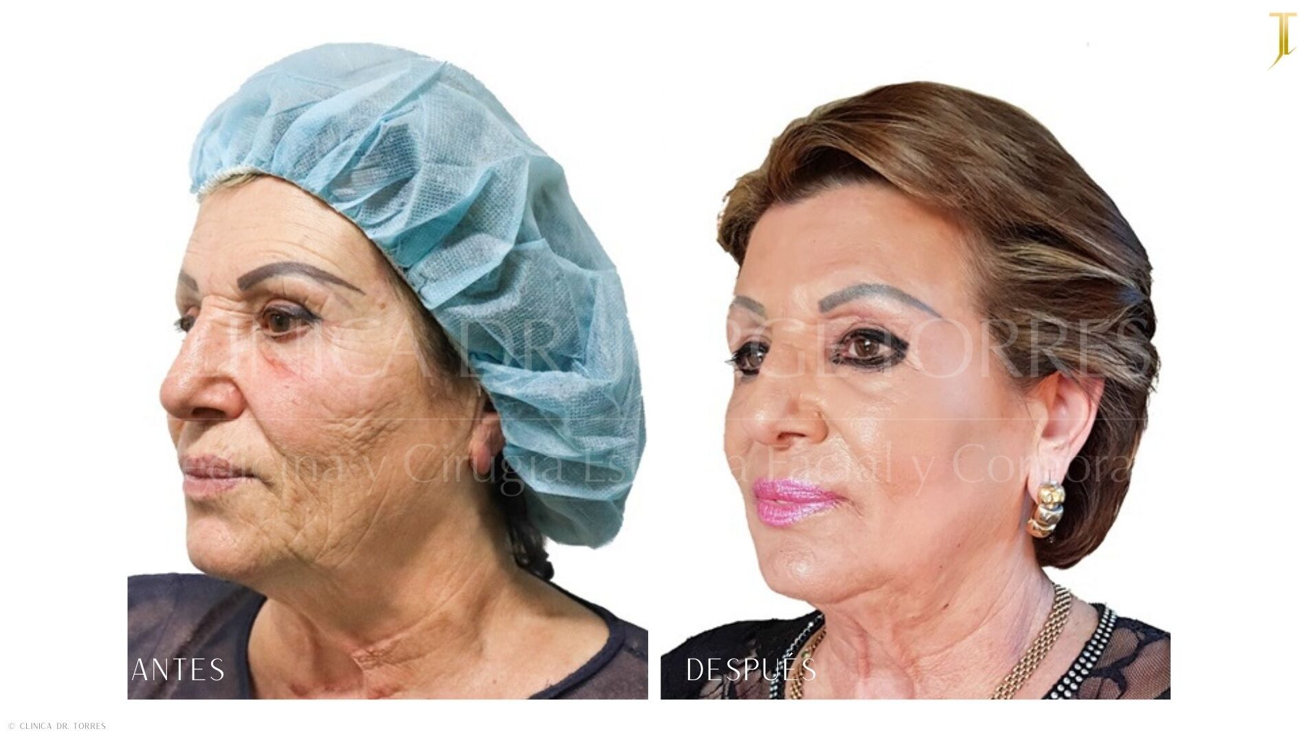 Peeling Profundo. Medicina y Cirugía Estética Facial y Corporal en Valencia Dr. Jorge Torres