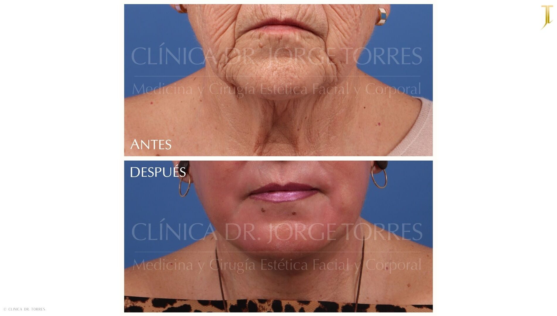 Peeling Profundo. Medicina y Cirugía Estética Facial y Corporal en Valencia Dr. Jorge Torres