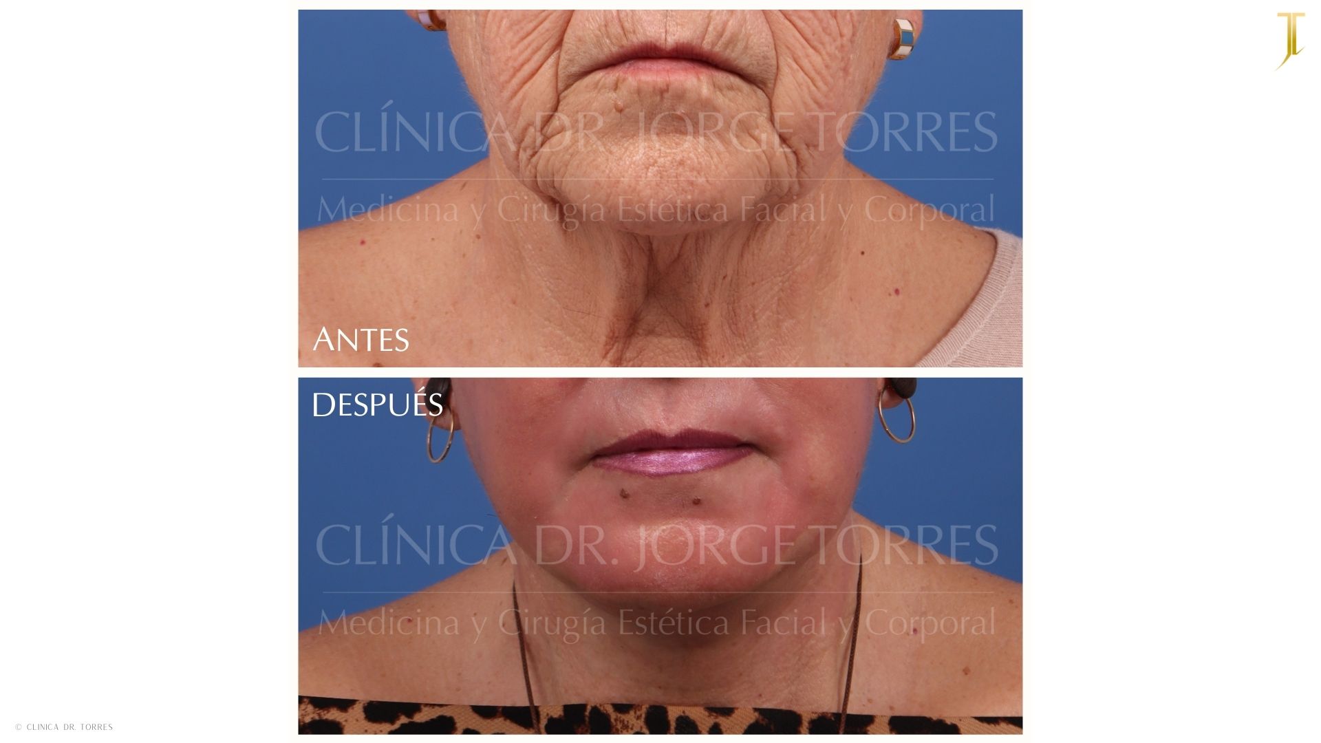 Peeling Profundo. Medicina y Cirugía Estética Facial y Corporal en Valencia Dr. Jorge Torres