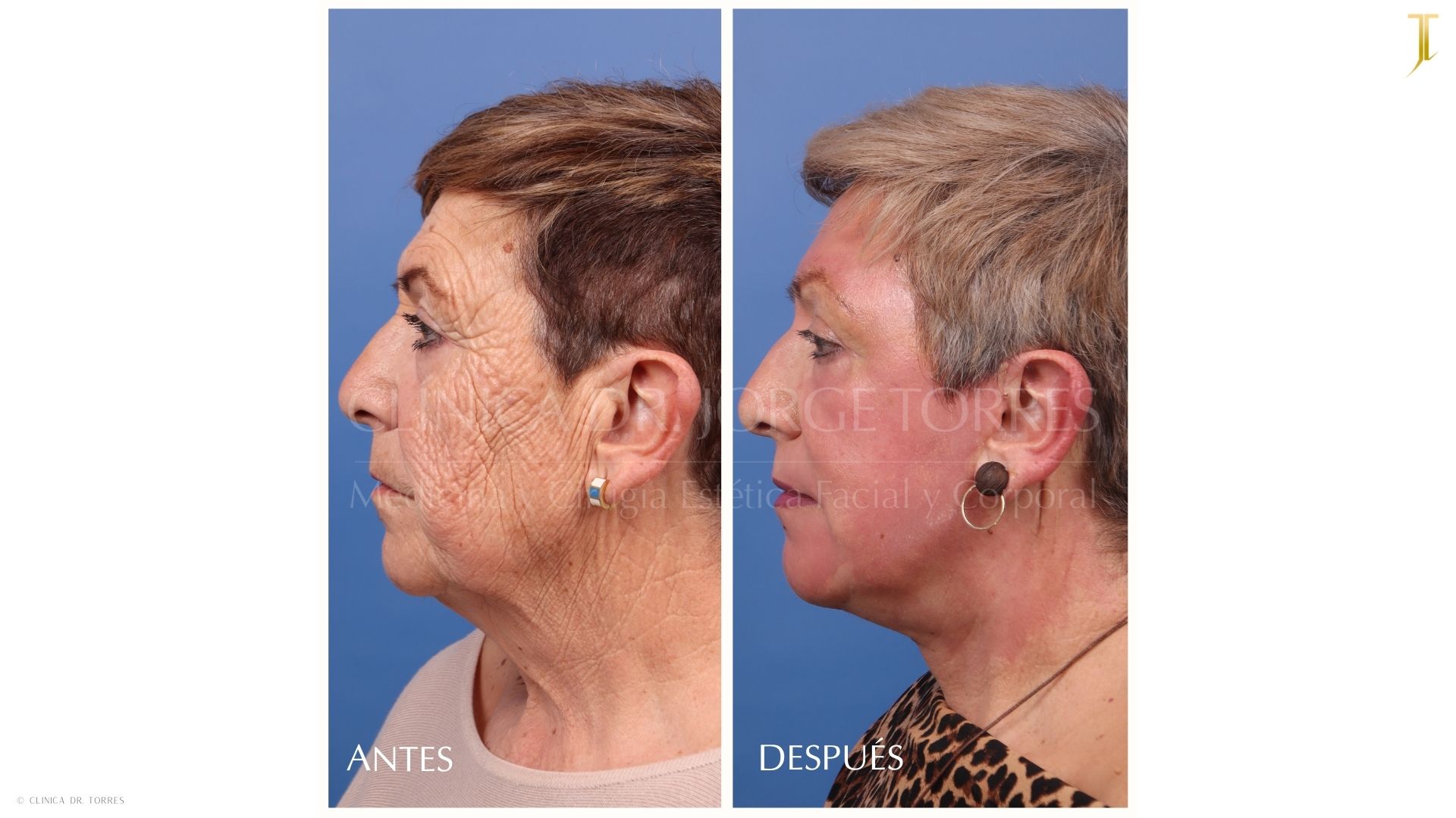 Peeling Profundo. Medicina y Cirugía Estética Facial y Corporal en Valencia Dr. Jorge Torres