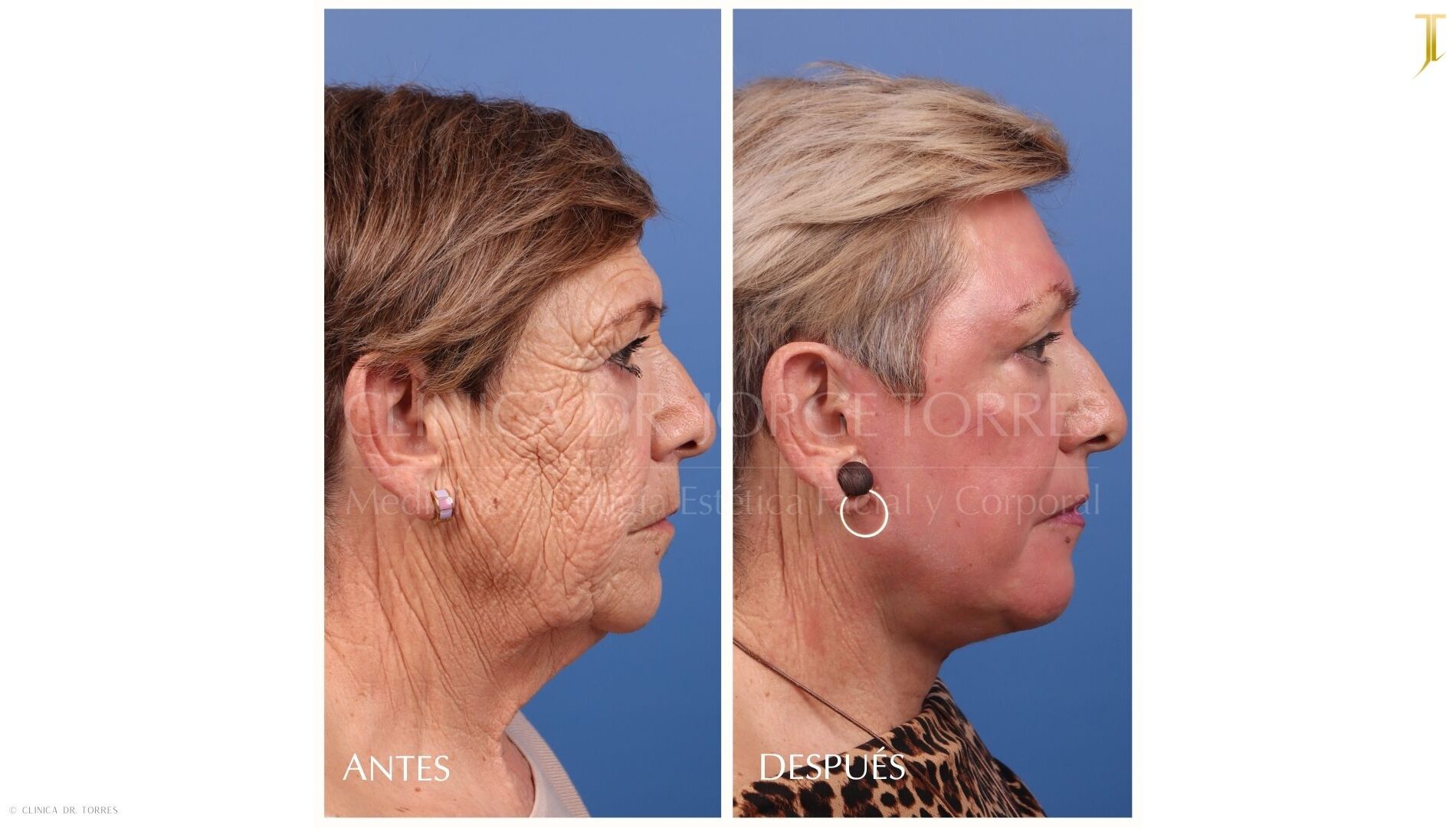 Peeling Profundo. Medicina y Cirugía Estética Facial y Corporal en Valencia Dr. Jorge Torres