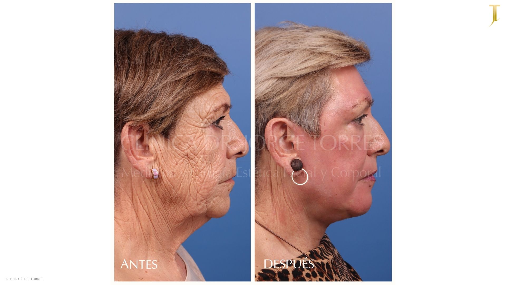 Peeling Profundo. Medicina y Cirugía Estética Facial y Corporal en Valencia Dr. Jorge Torres