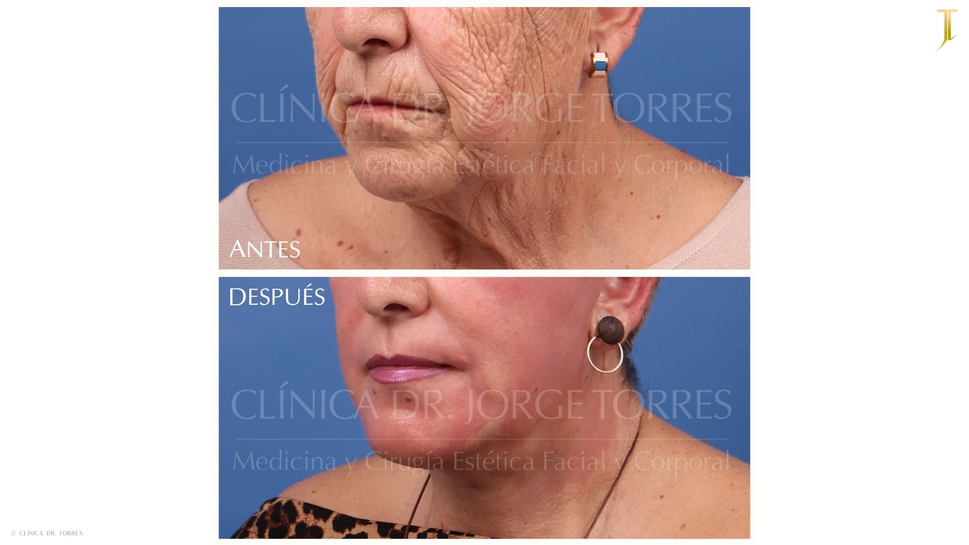 Peeling Profundo. Medicina y Cirugía Estética Facial y Corporal en Valencia Dr. Jorge Torres
