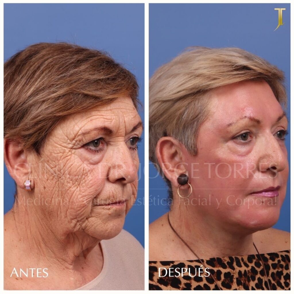 Peeling Profundo. Medicina y Cirugía Estética Facial y Corporal en Valencia Dr. Jorge Torres