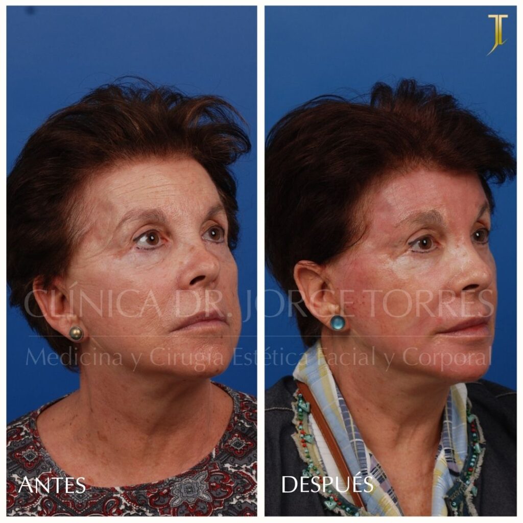 Peeling Profundo. Medicina y Cirugía Estética Facial y Corporal en Valencia Dr. Jorge Torres
