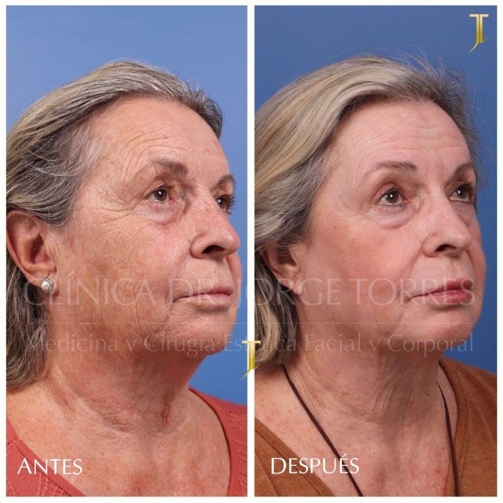 Peeling Profundo. Medicina y Cirugía Estética Facial y Corporal en Valencia Dr. Jorge Torres